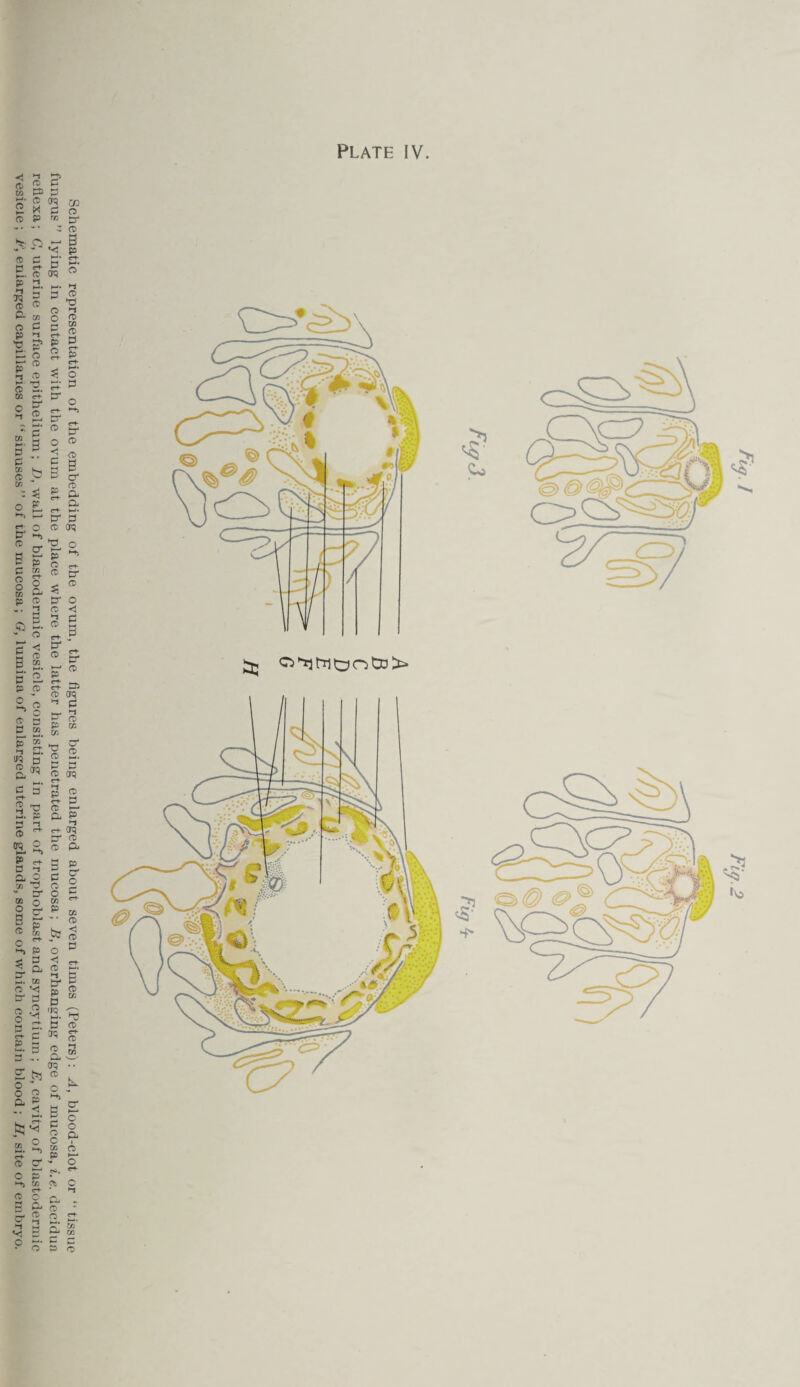 Schematic representation of the embedding of the ovum, the figures being enlarged about seven times (Peters): A, blood-clot or “ tissue fungus” lying in contact with the ovum at the place where the latter has penetrated the mucosa; B, overhanging edge of mucosa, i.e. decidua reflexa; C, uterine surface epithelium ; D, wall of blastodermic vesicle, consisting in part of trophoblast and syncytium ; E, cavity of blastodermic vesicle ; E, enlarged capillaries or '‘sinuses” of the mucosa; G, lumina of enlarged uterine glands, some of which contain blood ; II, site of embryo.