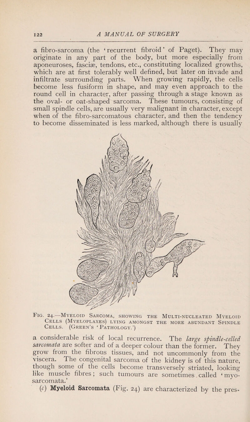 a fibro-sarcoma (the ‘recurrent fibroid’ of Paget). They may originate in any part of the body, but more especially from aponeuroses, fasciae, tendons, etc., constituting localized growths, which are at first tolerably well defined, but later on invade and infiltrate surrounding parts. When growing rapidly, the cells become less fusiform in shape, and may even approach to the round cell in character, after passing through a stage known as the oval- or oat-shaped sarcoma. These tumours, consisting of small spindle cells, are usually very malignant in character, except when of the fibro-sarcomatous character, and then the tendency to become disseminated is less marked, although there is usually Fig. 24.-—Myeloid Sarcoma, showing the Multi-nucleated Myeloid Cells (Myeloplaxes) lying amongst the more abundant Spindle Cells. (Green’s ‘Pathology.’) a considerable risk of local recurrence. The large spindle-celled sarcomata are softer and of a deeper colour than the former. They grow from the fibrous tissues, and not uncommonly from the viscera. The congenital sarcoma of the kidney is of this nature, though some of the cells become transversely striated, looking like muscle fibres; such tumours are sometimes. called ‘ myo- sarcomata.’ (c) Myeloid Sarcomata (Fig. 24) are characterized by the pres^