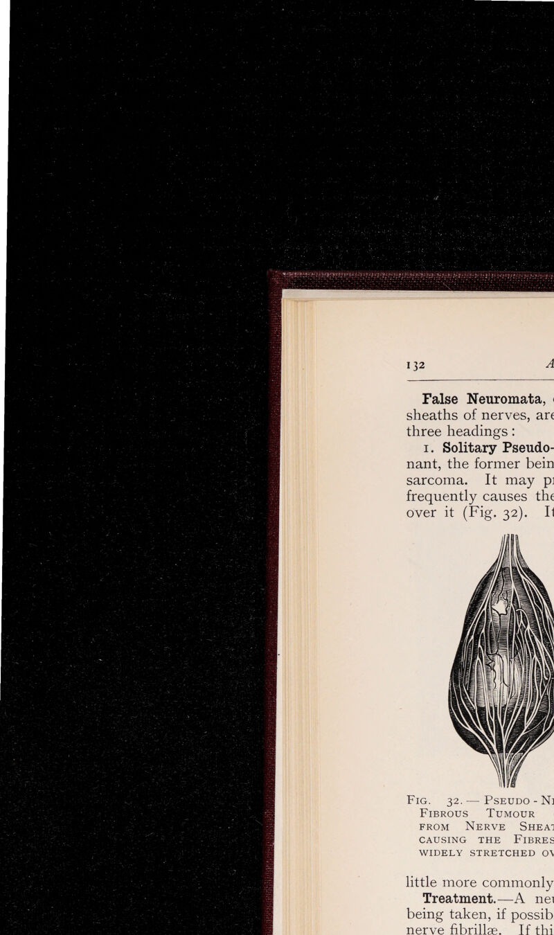 A False Neuromata, < sheaths of nerves, are three headings: i. Solitary Pseudo- nant, the former bein sarcoma. It may pi frequently causes the over it (Fig. 32). Il Fig. 32.— Pseudo - Ni Fibrous Tumour from Nerve Sheai CAUSING THE FIBRES WIDELY STRETCHED 0\ little more commonly Treatment.—A nei being taken, if possib nerve fibrillse. If thi
