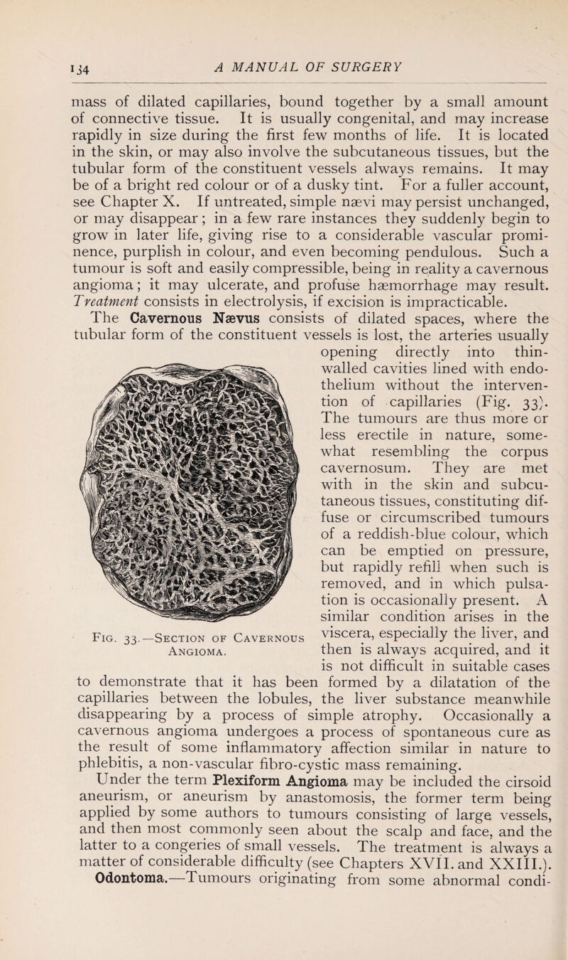 mass of dilated capillaries, bound together by a small amount of connective tissue. It is usually congenital, and may increase rapidly in size during the first few months of life. It is located in the skin, or may also involve the subcutaneous tissues, but the tubular form of the constituent vessels always remains. It may be of a bright red colour or of a dusky tint. For a fuller account, see Chapter X. If untreated, simple nsevi may persist unchanged, or may disappear; in a few rare instances they suddenly begin to grow in later life, giving rise to a considerable vascular promi¬ nence, purplish in colour, and even becoming pendulous. Such a tumour is soft and easily compressible, being in reality a cavernous angioma; it may ulcerate, and profuse haemorrhage may result. Treatment consists in electrolysis, if excision is impracticable. The Cavernous Naevus consists of dilated spaces, where the tubular form of the constituent vessels is lost, the arteries usually opening directly into thin- walled cavities lined with endo¬ thelium without the interven¬ tion of capillaries (Fig. 33). The tumours are thus more or less erectile in nature, some¬ what resembling the corpus cavernosum. They are met with in the skin and subcu¬ taneous tissues, constituting dif¬ fuse or circumscribed tumours of a reddish-blue colour, which can be emptied on pressure, but rapidly refill when such is removed, and in which pulsa¬ tion is occasionally present. A similar condition arises in the viscera, especially the liver, and then is always acquired, and it is not difficult in suitable cases to demonstrate that it has been formed by a dilatation of the capillaries between the lobules, the liver substance meanwhile disappearing by a process of simple atrophy. Occasionally a cavernous angioma undergoes a process of spontaneous cure as the result of some inflammatory affection similar in nature to phlebitis, a non-vascular fibro-cystic mass remaining. Under the term Plexiform Angioma may be included the cirsoid aneurism, or aneurism by anastomosis, the former term being applied by some authors to tumours consisting of large vessels, and then most commonly seen about the scalp and face, and the latter to a congeries of small vessels. The treatment is always a matter of considerable difficulty (see Chapters XVII. and XXIII.). Odontoma.—Tumours originating from some abnormal condi- Fig. 33- Section of Cavernous Angioma.