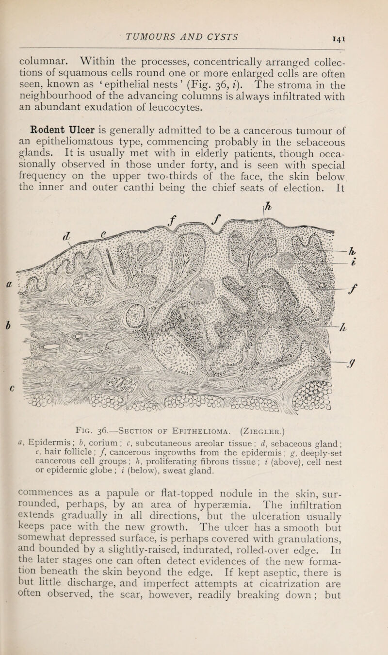 columnar. Within the processes, concentrically arranged collec¬ tions of squamous cells round one or more enlarged cells are often seen, known as ‘epithelial nests ’ (Fig. 36, i). The stroma in the neighbourhood of the advancing columns is always infiltrated with an abundant exudation of leucocytes. Rodent Ulcer is generally admitted to be a cancerous tumour of an epitheliomatous type, commencing probably in the sebaceous glands. It is usually met with in elderly patients, though occa¬ sionally observed in those under forty, and is seen with special frequency on the upper two-thirds of the face, the skin below the inner and outer canthi being the chief seats of election. It m Fig. 36.—Section of Epithelioma. (Ziegler.) a, Epidermis; b, corium ; c, subcutaneous areolar tissue; d, sebaceous gland; e, hair follicle; /, cancerous ingrowths from the epidermis; g, deeply-set cancerous cell groups; h, proliferating fibrous tissue; i (above), cell nest or epidermic globe ; i (below), sweat gland. commences as a papule or flat-topped nodule in the skin, sur¬ rounded, perhaps, by an area of hyperaemia. The infiltration extends gradually in all directions, but the ulceration usually keeps pace with the new growth. The ulcer has a smooth but somewhat depressed surface, is perhaps covered with granulations, and bounded by a slightly-raised, indurated, rolled-over edge. In the later stages one can often detect evidences of the new forma¬ tion beneath the skin beyond the edge. If kept aseptic, there is but little discharge, and imperfect attempts at cicatrization are often observed, the scar, however, readily breaking down ; but