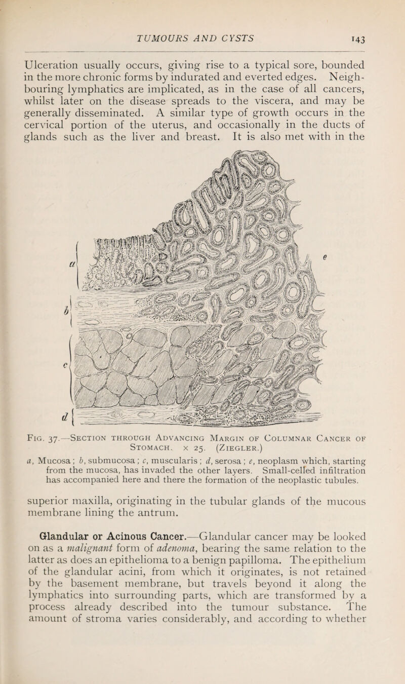 Ulceration usually occurs, giving rise to a typical sore, bounded in the more chronic forms by indurated and everted edges. Neigh¬ bouring lymphatics are implicated, as in the case of all cancers, whilst later on the disease spreads to the viscera, and may be generally disseminated. A similar type of growth occurs in the cervical portion of the uterus, and occasionally in the ducts of glands such as the liver and breast. It is also met with in the Fig. 37.—Section through Advancing Margin of Columnar Cancer of Stomach, x 25. (Ziegler.) a, Mucosa ; b, submucosa ; c, muscularis ; d, serosa ; e, neoplasm which, starting from the mucosa, has invaded the other layers. Small-celled infiltration has accompanied here and there the formation of the neoplastic tubules. superior maxilla, originating in the tubular glands of the mucous membrane lining the antrum. Glandular or Acinous Cancer.—Glandular cancer may be looked on as a malignant form of adenoma, bearing the same relation to the latter as does an epithelioma to a benign papilloma. The epithelium of the glandular acini, from which it originates, is not retained by the basement membrane, but travels beyond it along the lymphatics into surrounding parts, which are transformed by a process already described into the tumour substance. The amount of stroma varies considerably, and according to whether