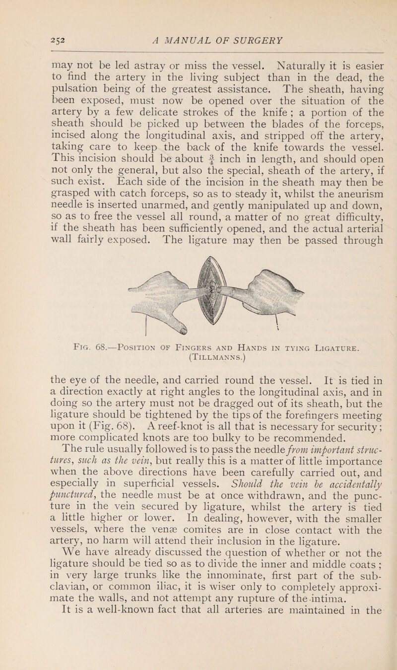 may not be led astray or miss the vessel. Naturally it is easier to find the artery in the living subject than in the dead, the pulsation being of the greatest assistance. The sheath, having been exposed, must now be opened over the situation of the artery by a few delicate strokes of the knife ; a portion of the sheath should be picked up between the blades of the forceps, incised along the longitudinal axis, and stripped off the artery, taking care to keep the back of the knife towards the vessel. This incision should be about f inch in length, and should open not only the general, but also the special, sheath of the artery, if such exist. Each side of the incision in the sheath may then be grasped with catch forceps, so as to steady it, whilst the aneurism needle is inserted unarmed, and gently manipulated up and down, so as to free the vessel all round, a matter of no great difficulty, if the sheath has been sufficiently opened, and the actual arterial wall fairly exposed. The ligature may then be passed through Fig. 68.—Position of Fingers and Hands in tying Ligature. (Tillmanns.) the eye of the needle, and carried round the vessel. It is tied in a direction exactly at right angles to the longitudinal axis, and in doing so the artery must not be dragged out of its sheath, but the ligature should be tightened by the tips of the forefingers meeting upon it (Fig. 68). A reef-knot is all that is necessary for security; more complicated knots are too bulky to be recommended. The rule usually followed is to pass the needlefrom important struc¬ tures, such as the vein, but really this is a matter of little importance when the above directions have been carefully carried out, and especially in superficial vessels. Should the vein be accidentally punctured, the needle must be at once withdrawn, and the punc¬ ture in the vein secured by ligature, whilst the artery is tied a little higher or lower. In dealing, however, with the smaller vessels, where the venae comites are in close contact with the artery, no harm will attend their inclusion in the ligature. We have already discussed the question of whether or not the ligature should be tied so as to divide the inner and middle coats ; in very large trunks like the innominate, first part of the sub¬ clavian, or common iliac, it is wiser only to completely approxi¬ mate the walls, and not attempt any rupture of the-intima. It is a well-known fact that all arteries are maintained in the