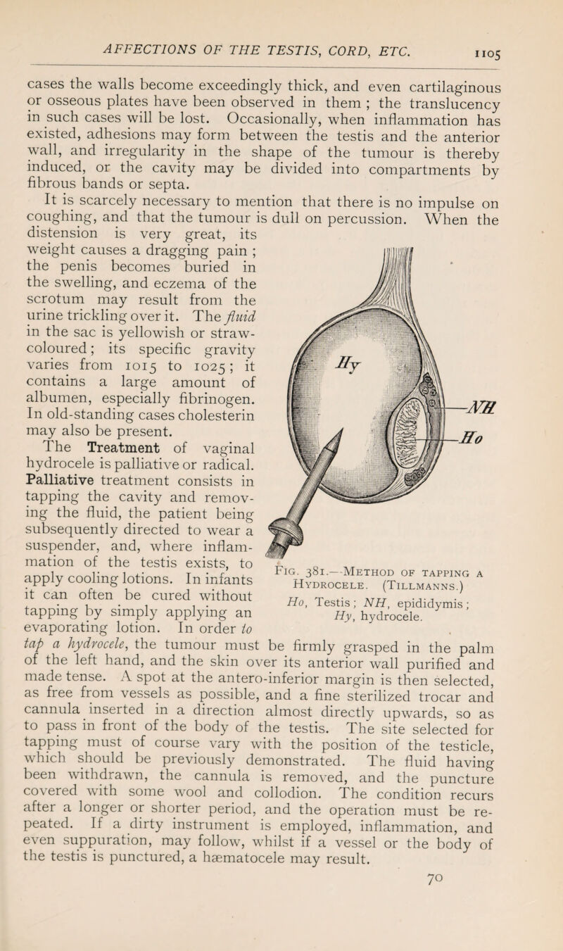 cases the walls become exceedingly thick, and even cartilaginous or osseous plates have been observed in them ; the translucency in such cases will be lost. Occasionally, when inflammation has existed, adhesions may form between the testis and the anterior wall, and irregularity in the shape of the tumour is thereby induced, or the cavity may be divided into compartments by fibrous bands or septa. It is scarcely necessary to mention that there is no impulse on coughing, and that the tumour is dull on percussion. When the distension is very great, its weight causes a dragging pain ; the penis becomes buried in the swelling, and eczema of the scrotum may result from the urine trickling over it. The fluid in the sac is yellowish or straw- coloured ; its specific gravity varies from 1015 to 1025; it contains a large amount of albumen, especially fibrinogen. In old-standing cases cholesterin may also be present. The Treatment of vaginal hydrocele is palliative or radical. Palliative treatment consists in tapping the cavity and remov¬ ing the fluid, the patient being subsequently directed to wear a suspender, and, where inflam¬ mation of the testis exists, to apply cooling lotions. In infants it can often be cured without tapping by simply applying an evaporating lotion. In order io tap a hydrocele, the tumour must be firmly grasped in the palm of the left hand, and the skin over its anterior wall purified and made tense. A spot at the antero-inferior margin is then selected, as free from vessels as possible, and a fine sterilized trocar and cannula inserted in a direction almost directly upwards, so as to pass in front of the body of the testis. The site selected for tapping must of course vary with the position of the testicle, which should be previously demonstrated. The fluid having been withdrawn, the cannula is removed, and the puncture covered with some wool and collodion. The condition recurs after a longer or shorter period, and the operation must be re¬ peated. If a dirty instrument is employed, inflammation, and even suppuration, may follow, whilst if a vessel or the body of the testis is punctured, a haematocele may result. Fig. 381.—Method of tapping a Hydrocele. (Tillmanns.) Ho, Testis ; NH, epididymis ; Hy, hydrocele. 70