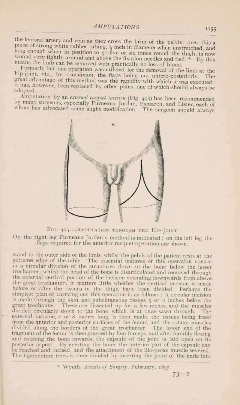 “55 the femoral artery and vein as they cross the brim of the pelvis; over this a piece of strong white rubber tubing, i inch in diameter when unstretched and ong enough when in position to go five or six times round the thigh, is'now wound very tightly around and above the fixation needles and tied.’* By this means the limb can be removed with practically no loss of blood. , . Formerly but one operation was utilized for the removal of the limb at the hip-joint, viz., by transfixion, the flaps being cut antero-posteriorly. The great advantage of this method was the rapidity with which it was executed ; it has, however, been replaced by other plans, one of which should always be adopted. J Amputation by an external racquet incision (Fig. 405) has been recommended by many surgeons, especially Furneaux Jordan, Esmarch, and Lister, each of vhom has advocated some slight modification. The surgeon should always Fig. 405.—Amputation through the Hip-Joint. On the right leg Furneaux Jordan’s method is indicated ; on the left leg the flaps required for the anterior racquet operation are shown. stand to the outer side of the limb, whilst the pelvis of the patient rests at the extreme edge of the table. The essential features of this operation consist in a circular division of the structures down to the bone below the lesser trochanter, whilst the head of the bone is disarticulated and removed through the external vertical portion of the incision extending downwards from above the great trochanter; it matters little whether the vertical incision is made before or after the tissues in the thigh have been divided. Perhaps the simplest plan of carrying out this operation is as follows : A circular incision is made through the skin and subcutaneous tissues 5 or 6 inches below the great trochanter. These are dissected up for a few inches, and the muscles divided circularly down to the bone, which is at once sawn through. The external incision, 6 or 8 inches long, is then made, the tissues being freed from the anterior and posterior surfaces of the femur, and the rotator muscles divided along the borders of the great trochanter. The lower end of the fragment of the femur is then grasped by lion forceps, and after forcibly flexing and rotating the bone inwards, the capsule of the joint is laid open on its posterior aspect. By everting the bone, the anterior part of the capsule can be reached and incised, and the attachment of the ilio-psoas muscle severed. The ligamentum teres is then divided by inserting the point of the knife into Wyeth, Annals of Surgery, February, 1897. 73—2