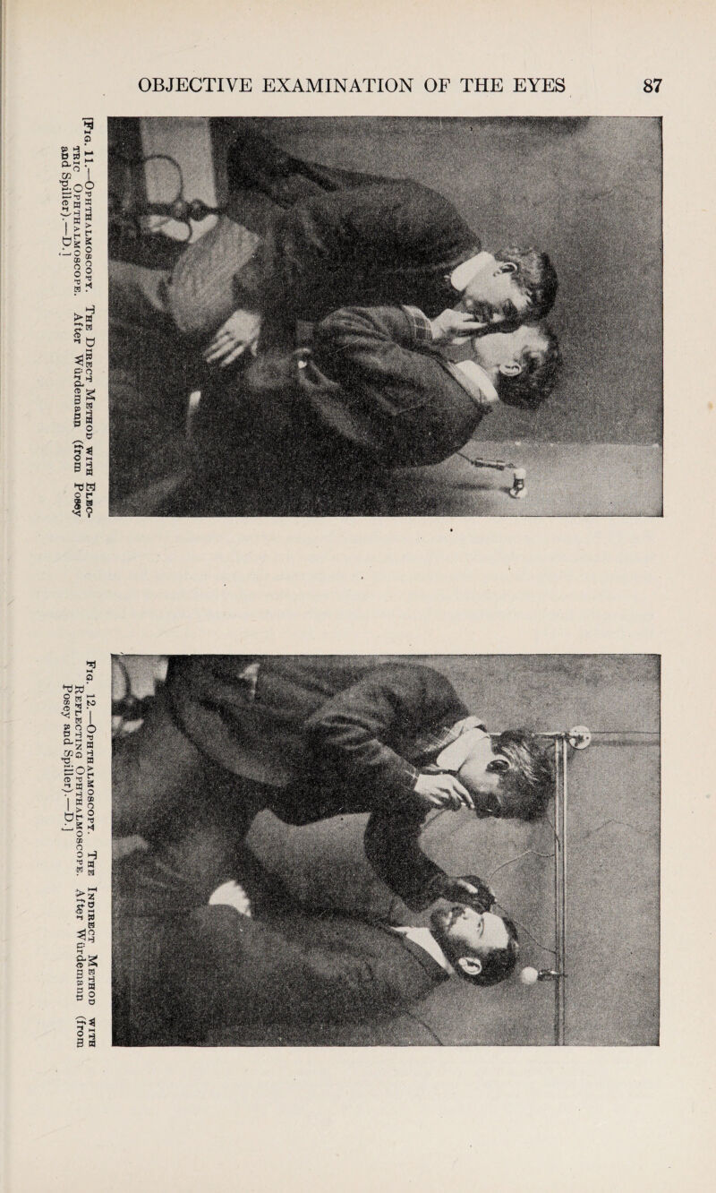 [Fig. 11.—Ophthalmoscopy. The Direct Method with Elec- Fig. 12.—Ophthalmoscopy. The Indirect Method with tric Ophthalmoscope. After Wtirdemann (from Posey Reflecting Ophthalmoscope. After Wiirdemann (from and Spiller).—D.l Posey and Spiller).—D.]