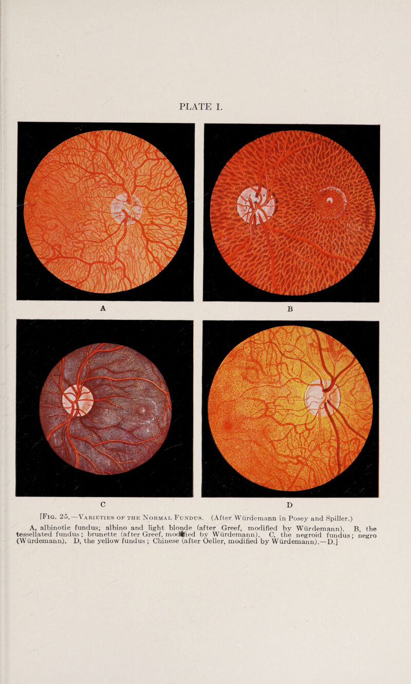 PLATE I Tig. 25. Varieties of the Normal Fundus. (After Wurdemann in Posey and Spiller.) A, albinotic fundus; albino and light blonde (after Greef, modified by Wurdemann). B, the tessellated fundus; brunette (after Greef, modified by Wurdemann). C, the negroid fundus; negro (Wurdemann). D, the yellow fundus ; Chinese (after Oeller, modified by Wurdemann).—D.]