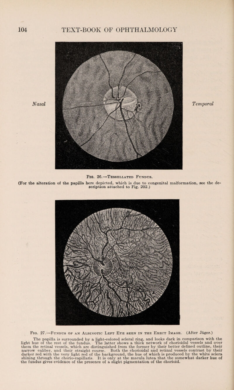 Fig. 26.—Tessellated Fundus. (For the alteration of the papilla here depicted, which is due to congenital malformation, see the de¬ scription attached to Fig. 202.) Fig. 27.—Fundus of an Albinotic Left Ete seen in the Erect Image. (After Jager.) The papilla is surrounded by a light-colored scleral ring, and looks dark in comparison with the light hue of the rest of the fundus. The latter shows a thick network of chorioidal vessels and over them the retinal vessels, which are distinguished from the former by their better defined outline, their narrow caliber, and their straight course. Both the chorioidal and retinal vessels contrast by their darker red with the very light red of the background, the hue of which is produced by the white sclera shining through the chorio-capillaris. It is only at the macula lutea that the somewhat darker hue of the fundus gives evidence of the presence of a slight pigmentation of the chorioid.