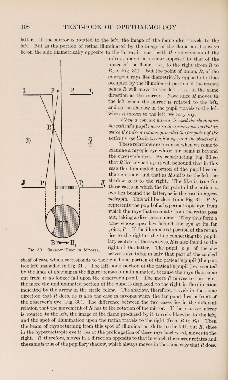 latter. If the mirror is rotated to the left, the image of the flame also travels to the left. But as the portion of retina illuminated by the image of the flame must always lie on the side diametrically opposite to the latter, it must, with the movements of the mirror, move in a sense opposed to that of the image of the flame—i.e., to the right (from B to Bi in Fig. 30). But the point of union, R, of the emergent rays lies diametrically opposite to that occupied by the illuminated portion of the retina; hence R will move to the left—i.e., in the same direction as the mirror. Now since R moves to the left when the mirror is rotated to the left, and as the shadow in the pupil travels to the left when R moves to the left, we may say, When a concave mirror is used the shadow in the patient1 s pupil moves in the same sense as that in which the mirror rotates, provided the far point of the patient's eye lies between his eye and the observer’s. These relations are reversed when we come to examine a myopic eye whose far point is beyond the observer’s eye. By constructing Fig. 30 so that R lies beyond i p, it will be found that in this case the illuminated portion of the pupil lies on the right side, and that as R shifts to the left the shadow goes to the right. The like is true for those cases in which the far point of the patient’s eye lies behind the latter, as is the case in hyper- metropia. This will be clear from Fig. 31. P Pi represents the pupil of a hypermetropic eye, from which the rays that emanate from the retina pass out, taking a divergent course. They thus form a cone whose apex lies behind the eye at its far point, R. If the illuminated portion of the retina lies to the right of the line connecting the pupil¬ lary centers of the two eyes, R is also found to the right of the latter. The pupil, p px of the ob¬ server’s eye takes in only that part of the conical Fig. 30.—Shadow Test in Myopia. sheaf of rays which corresponds to the right-hand portion of the patient’s pupil (the por¬ tion left unshaded in Fig. 31). The left-hand portion of the patient’s pupil (represented by the lines of shading in the figure) remains unilluminated, because the rays that come out from it no longer fall upon the observer’s pupil. The more R moves to the right, the more the unilluminated portion of the pupil is displaced to the right in the direction indicated by the arrow in the circle below. The shadow, therefore, travels in the same direction that R does, as is also the case in myopia when the far point lies in front of the observer’s eye (Fig. 30). The difference between the two cases lies in the different relation that the movement of R has to the rotation of the mirror. If the concave mirror is rotated to the left, the image of the flame produced by it travels likewise to the left, and the spot of illumination upon the retina travels to the right (from B to Bf). Then the beam of rays returning from this spot of illumination shifts to the left, but R, since in the hypermetropic eye it lies at the prolongation of these rays backward, moves to the right. R, therefore, moves in a direction opposite to that in which the mirror rotates and the same is true of the pupillary shadow, which always moves in the same way that R does.