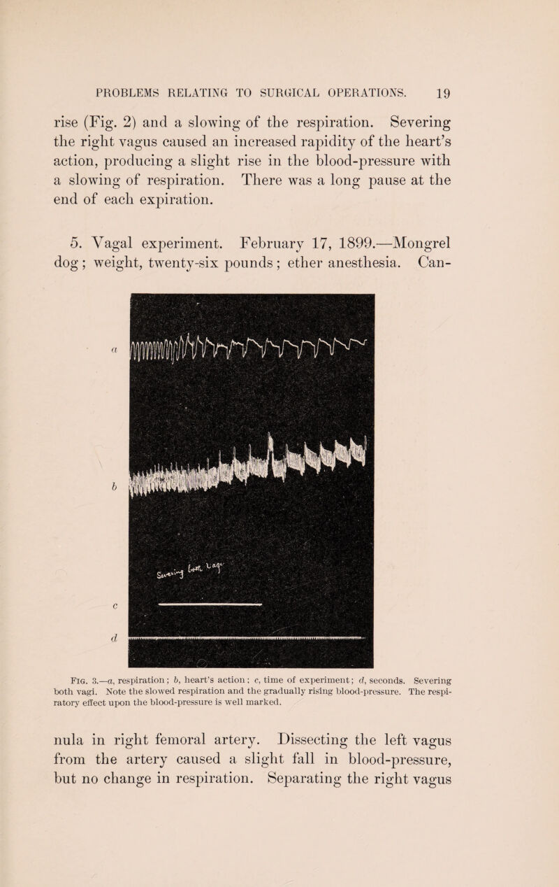rise (Fig. 2) and a slowing of the respiration. Severing the right vagus caused an increased rapidity of the heart’s action, producing a slight rise in the blood-pressure with a slowing of respiration. There was a long pause at the end of each expiration. 5. Vagal experiment. February 17, 1899.—Mongrel dog ; weight, twenty-six pounds ; ether anesthesia. Can¬ oe. \ b c d Fig. 3.—a, respiration ; b, heart’s action ; c, time of experiment; d, seconds. Severing both vagi. Note the slowed respiration and the gradually rising blood-pressure. The respi¬ ratory effect upon the blood-pressure is well marked. nula in right femoral artery. Dissecting the left vagus from the artery caused a slight fall in blood-pressure, but no change in respiration. Separating the right vagus