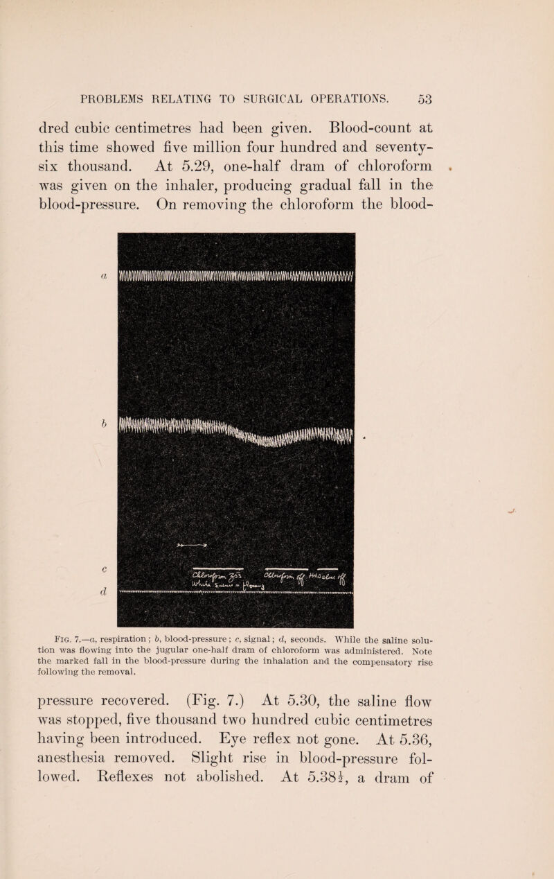 dred cubic centimetres had been given. Blood-count at this time showed five million four hundred and seventy- six thousand. At 5.29, one-half dram of chloroform was given on the inhaler, producing gradual fall in the blood-pressure. On removing the chloroform the blood- Fig. 7.—a, respiration; b, blood-pressure ; c, signal; cl, seconds. While the saline solu¬ tion was flowing into the jugular one-half dram of chloroform was administered. Note the marked fall in the blood-pressure during the inhalation and the compensatory rise following the removal. pressure recovered. (Fig. 7.) At 5.30, the saline flow was stopped, five thousand two hundred cubic centimetres having been introduced. Eye reflex not gone. At 5.36, anesthesia removed. Slight rise in blood-pressure fol¬ lowed. Reflexes not abolished. At 5.38i, a dram of
