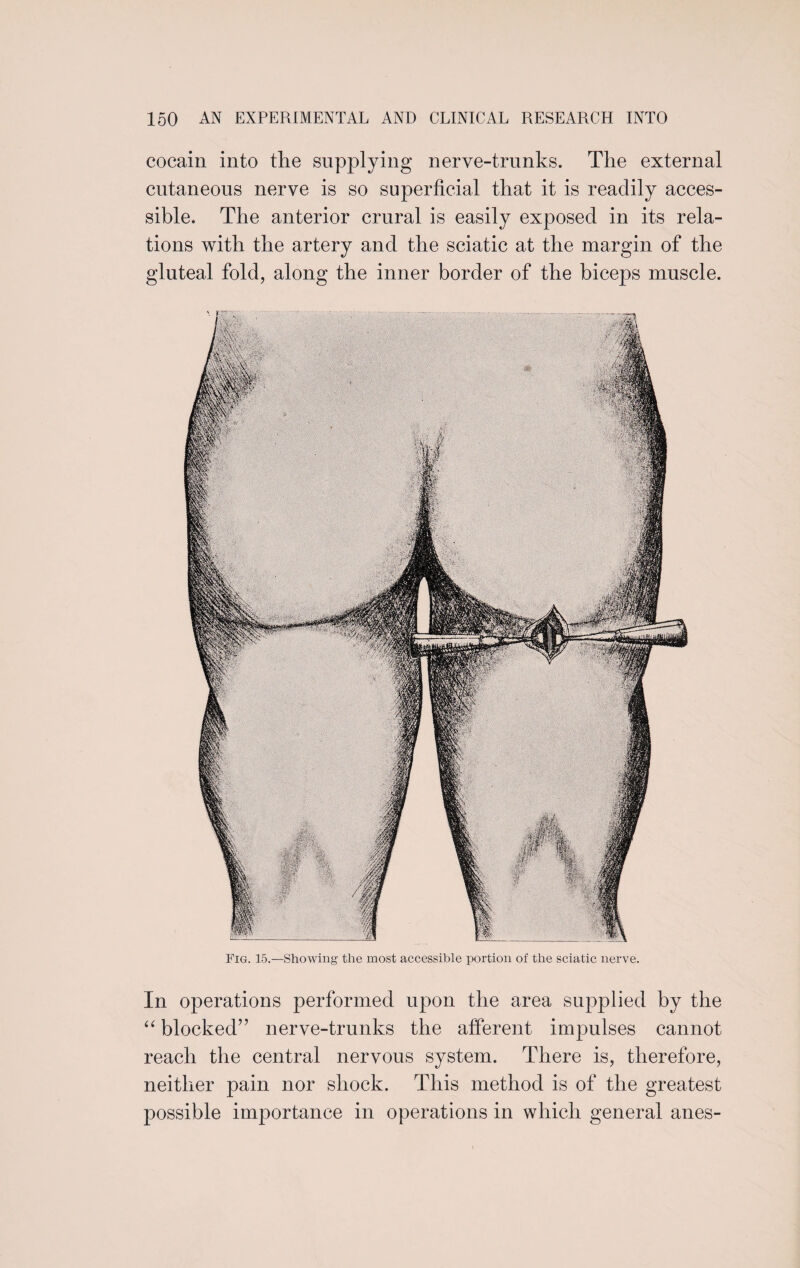 In operations performed upon the area supplied by the “ blocked” nerve-trunks the afferent impulses cannot reach the central nervous system. There is, therefore, neither pain nor shock. This method is of the greatest possible importance in operations in which general anes- 150 AN EXPERIMENTAL AND CLINICAL RESEARCH INTO cocain into the supplying nerve-trunks. The external cutaneous nerve is so superficial that it is readily acces¬ sible. The anterior crural is easily exposed in its rela¬ tions with the artery and the sciatic at the margin of the gluteal fold, along the inner border of the biceps muscle. Fig. 15.—Showing the most accessible portion of the sciatic nerve.