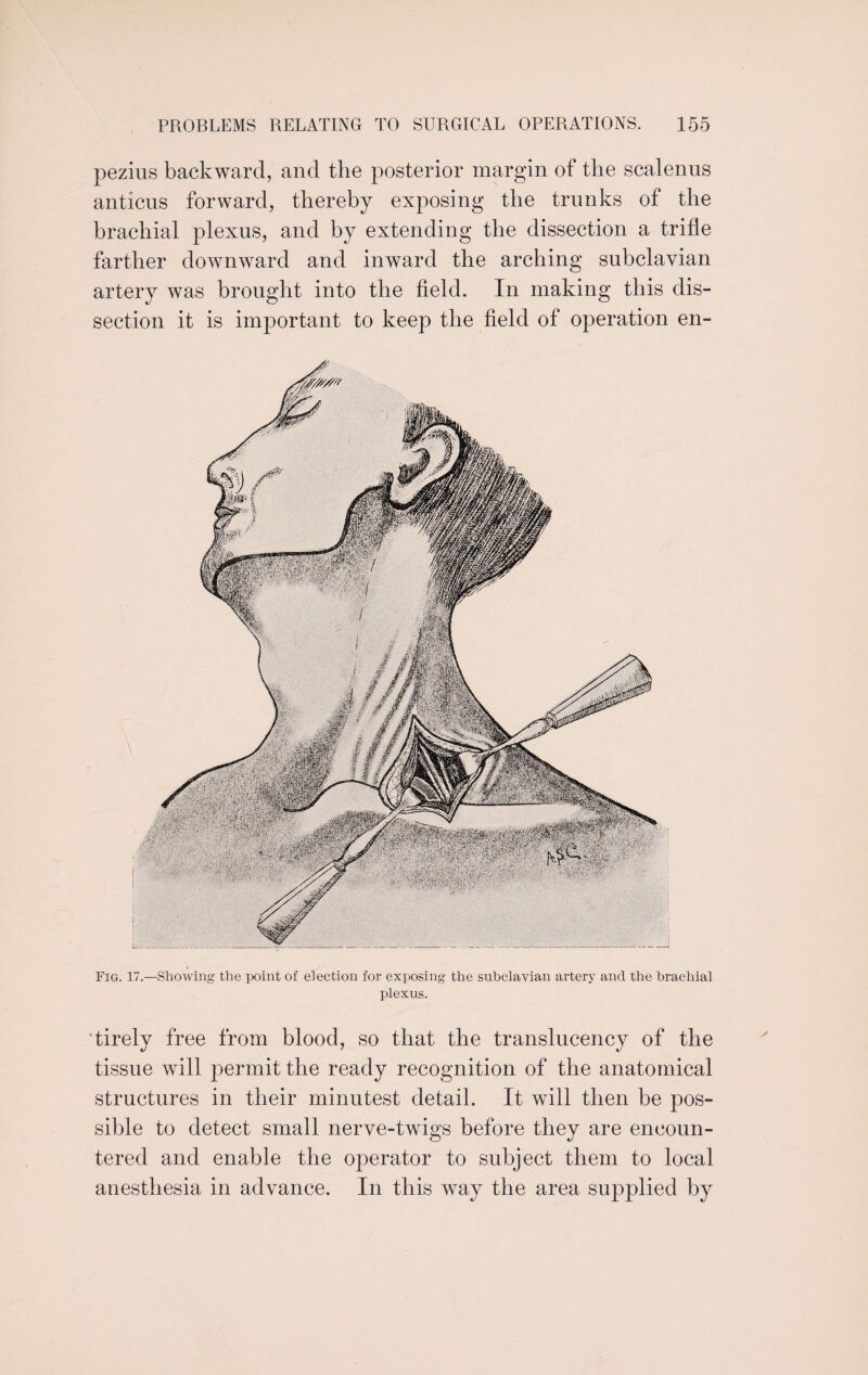 pezius backward, and the posterior margin of the scalenus anticus forward, thereby exposing the trunks of the brachial plexus, and by extending the dissection a trifle farther downward and inward the arching subclavian artery was brought into the field. In making this dis¬ section it is important to keep the field of operation en- Fig. 17.—Showing the point of election for exposing the subclavian artery and the brachial plexus. tirely free from blood, so that the translucency of the tissue will permit the ready recognition of the anatomical structures in their minutest detail. It will then be pos¬ sible to detect small nerve-twigs before they are encoun¬ tered and enable the operator to subject them to local anesthesia in advance. In this way the area supplied by