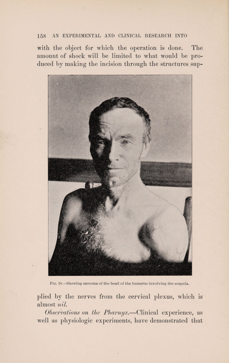 with the object for which the operation is done. The amount of shock will he limited to what would be pro¬ duced by making the incision through the structures sup- Fig. 18.—Showing sarcoma of the head of the humerus involving the scapula. plied by the nerves from the cervical plexus, which is almost nil. Observations on the Pharnyx.—Clinical experience, as well as physiologic experiments, have demonstrated that