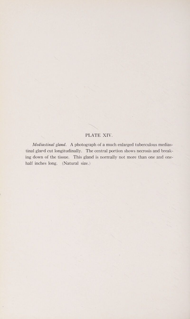 Mediastinal gland. A photograph of a much enlarged tuberculous medias¬ tinal gland cut longitudinally. The central portion shows necrosis and break¬ ing down of the tissue. This gland is normally not more than one and one- half inches long. (Natural size.)