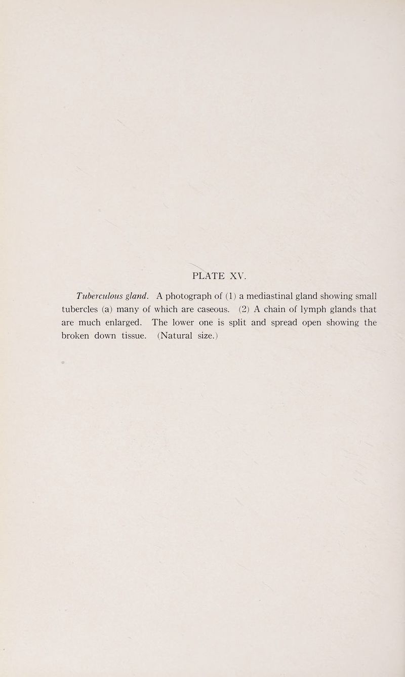 Tuberculous gland. A photograph of (1) a mediastinal gland showing small tubercles (a) many of which are caseous. (2) A chain of lymph glands that are much enlarged. The lower one is split and spread open showing the broken down tissue. (Natural size.)