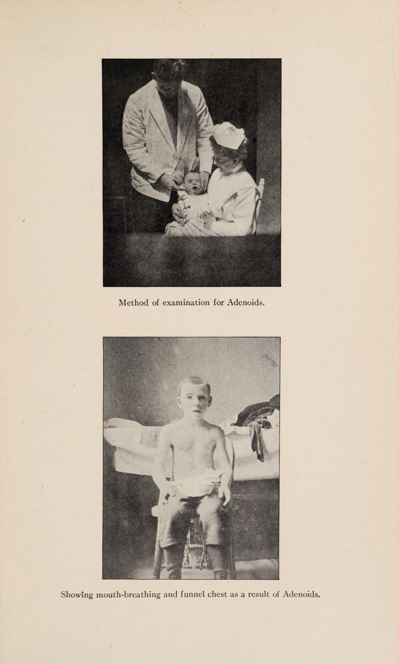 Method of examination for Adenoids. Showing mouth-breathing and funnel chest as a result of Adenoids