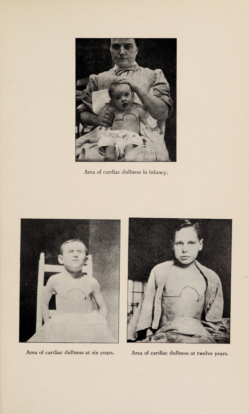 Area of cardiac dullness in infancy. Area of cardiac dullness at six years. Area of cardiac dullness at twelve years.