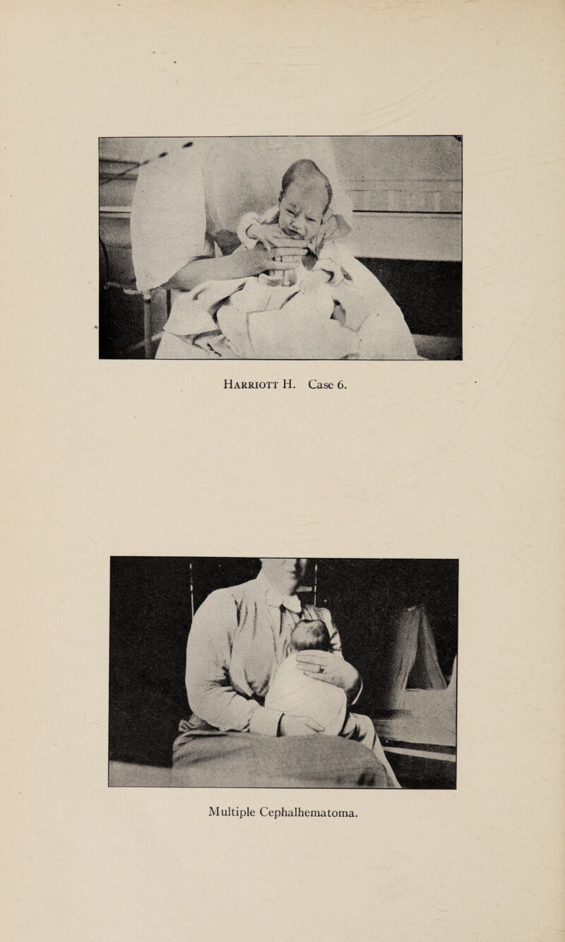 Harriott H. Case 6. Multiple Cephalhematoma