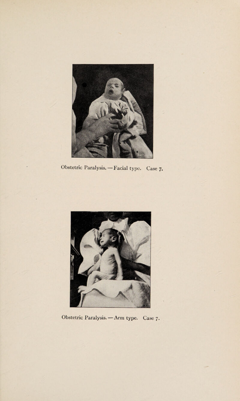 Obstetric Paralysis.—Arm type. Case 7.