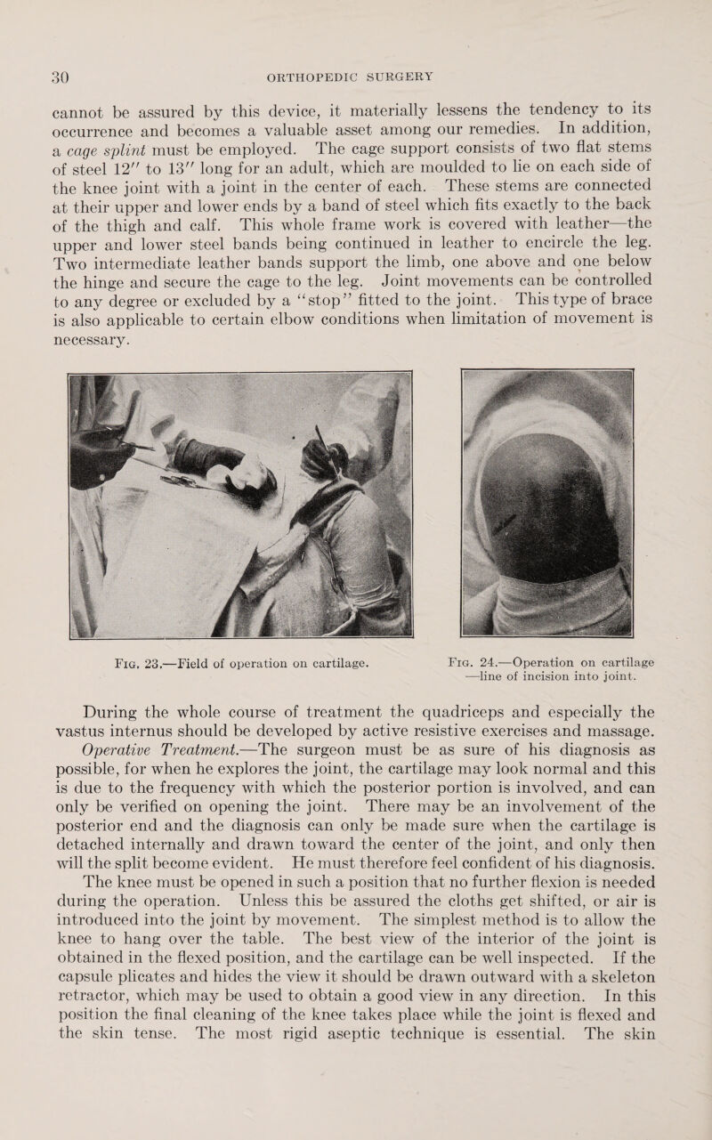 cannot be assured by this device, it materially lessens the tendency to its occurrence and becomes a valuable asset among our remedies. In addition, a cage splint must be employed. The cage support consists of two flat stems of steel 12 to 13 long for an adult, which are moulded to lie on each side of the knee joint with a joint in the center of each. These stems are connected at their upper and lower ends by a band of steel which fits exactly to the back of the thigh and calf. This whole frame work is covered with leather—the upper and lower steel bands being continued in leather to encircle the leg. Two intermediate leather bands support the limb, one above and one below the hinge and secure the cage to the leg. Joint movements can be controlled to any degree or excluded by a stop fitted to the joint. This type of brace is also applicable to certain elbow conditions when limitation of movement is necessary. Fig. 23.—Field of operation on cartilage. Fig. 24.—Operation on cartilage —line of incision into joint. During the whole course of treatment the quadriceps and especially the vastus internus should be developed by active resistive exercises and massage. Operative Treatment.—The surgeon must be as sure of his diagnosis as possible, for when he explores the joint, the cartilage may look normal and this is due to the frequency with which the posterior portion is involved, and can only be verified on opening the joint. There may be an involvement of the posterior end and the diagnosis can only be made sure when the cartilage is detached internally and drawn toward the center of the joint, and only then will the split become evident. He must therefore feel confident of his diagnosis. The knee must be opened in such a position that no further flexion is needed during the operation. Unless this be assured the cloths get shifted, or air is introduced into the joint by movement. The simplest method is to allow the knee to hang over the table. The best view of the interior of the joint is obtained in the flexed position, and the cartilage can be well inspected. If the capsule plicates and hides the view it should be drawn outward with a skeleton retractor, which may be used to obtain a good view in any direction. In this position the final cleaning of the knee takes place while the joint is flexed and the skin tense. The most rigid aseptic technique is essential. The skin