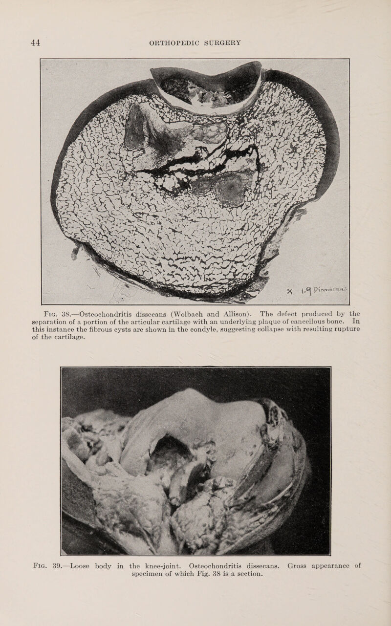 Fig. 38.—Osteochondritis dissecans (Wolbach and Allison). The defect produced by the separation of a portion of the articular cartilage with an underlying plaque of cancellous bone. In this instance the fibrous cysts are shown in the condyle, suggesting collapse with resulting rupture of the cartilage. Fig. 39.—Loose body in the knee-joint. Osteochondritis dissecans. Gross appearance of specimen of which Fig. 38 is a section.