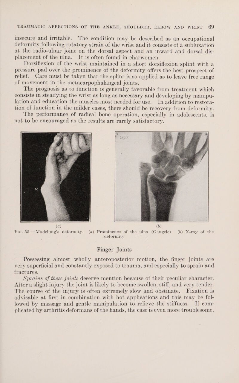 insecure and irritable. The condition may be described as an occupational deformity following rotatory strain of the wrist and it consists of a subluxation at the radio-ulnar joint on the dorsal aspect and an inward and dorsal dis¬ placement of the ulna. It is often found in charwomen. Dorsiflexion of the wrist maintained in a short dorsiflexion splint with a pressure pad over the prominence of the deformity offers the best prospect of relief. Care must be taken that the splint is so applied as to leave free range of movement in the metacarpophalangeal joints. The prognosis as to function is generally favorable from treatment which consists in steadying the wrist as long as necessary and developing by manipu¬ lation and education the muscles most needed for use. In addition to restora¬ tion of function in the milder cases, there should be recovery from deformity. The performance of radical bone operation, especially in adolescents, is not to be encouraged as the results are rarely satisfactory. (a) (6) Fig. 55.— Madelung’s deformity, (a) Prominence of the ulna (Gaugele). (b) X-ray of the deformity Finger Joints Possessing almost wholly anteroposterior motion, the finger joints are very superficial and constantly exposed to trauma, and especially to sprain and fractures. Sprains of these joints deserve mention because of their peculiar character. After a slight injury the joint is likely to become swollen, stiff, and very tender. The course of the injury is often extremely slow and obstinate. Fixation is advisable at first in combination with hot applications and this may be fol¬ lowed by massage and gentle manipulation to relieve the stiffness. If com¬ plicated by arthritis deformans of the hands, the case is even more troublesome.