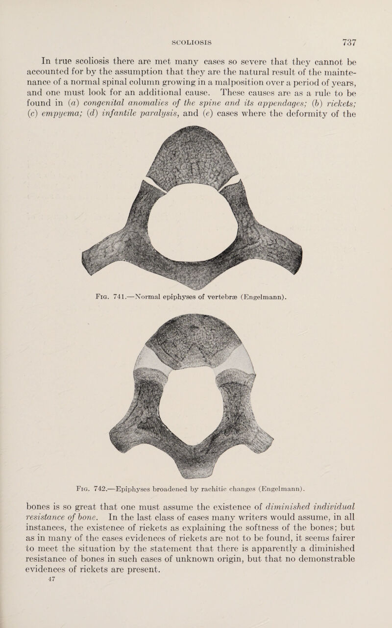 In true scoliosis there are met many cases so severe that they cannot be accounted for by the assumption that they are the natural result of the mainte¬ nance of a normal spinal column growing in a malposition over a period of years, and one must look for an additional cause. These causes are as a rule to be found in (a) congenital anomalies of the spine and its appendages; (b) rickets; (c) empyema; (d) infantile paralysis, and (e) cases where the deformity of the Fig. 741.—Normal epiphyses of vertebrae (Engelmann). Fig. 742.—Epiphyses broadened by rachitic changes (Engelmann). bones is so great that one must assume the existence of diminished individual resistance of bone. In the last class of cases many writers would assume, in all instances, the existence of rickets as explaining the softness of the bones; but as in many of the cases evidences of rickets are not to be found, it seems fairer to meet the situation by the statement that there is apparently a diminished resistance of bones in such cases of unknown origin, but that no demonstrable evidences of rickets are present. 47