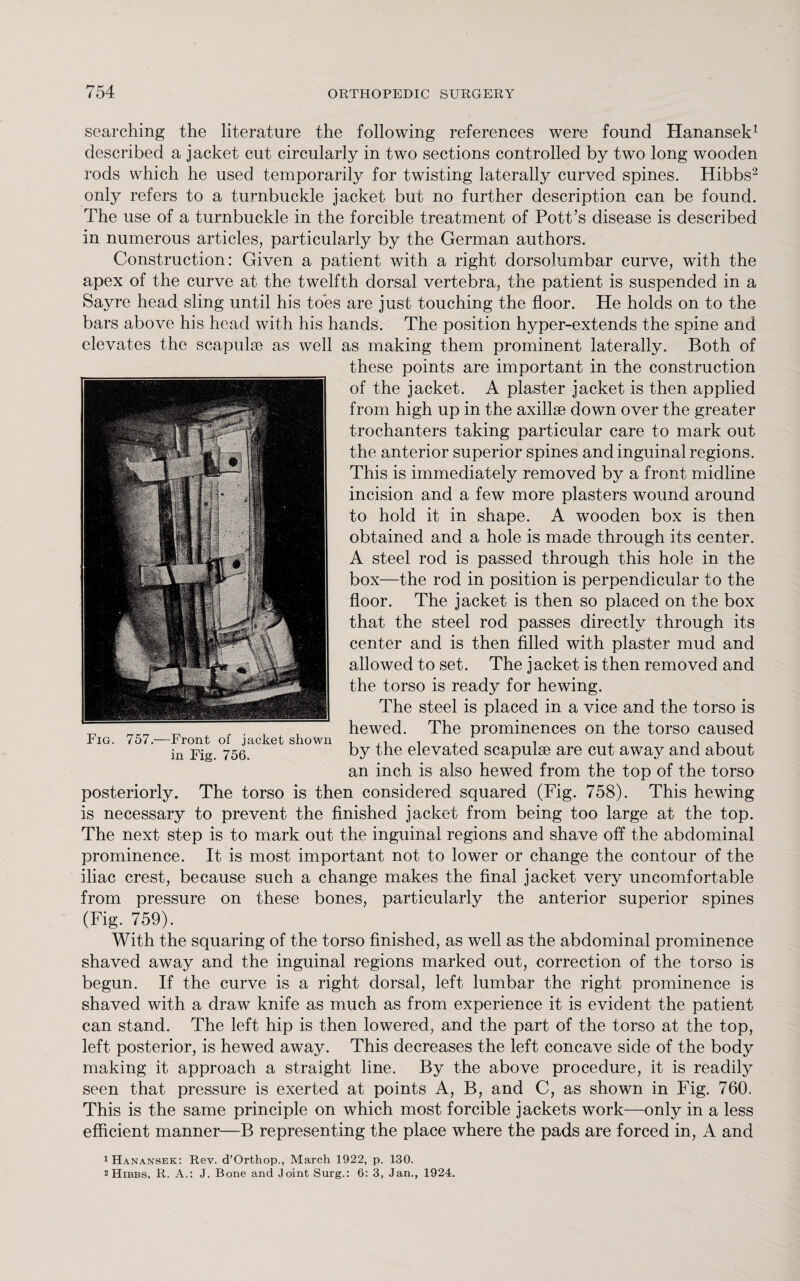 searching the literature the following references were found Hanansek1 described a jacket cut circularly in two sections controlled by two long wooden rods which he used temporarily for twisting laterally curved spines. Hibbs2 only refers to a turnbuckle jacket but no further description can be found. The use of a turnbuckle in the forcible treatment of Pott’s disease is described in numerous articles, particularly by the German authors. Construction: Given a patient with a right dorsolumbar curve, with the apex of the curve at the twelfth dorsal vertebra, the patient is suspended in a Sayre head sling until his toes are just touching the floor. He holds on to the bars above his head with his hands. The position hyper-extends the spine and elevates the scapulae as well as making them prominent laterally. Both of these points are important in the construction of the jacket. A plaster jacket is then applied from high up in the axillae down over the greater trochanters taking particular care to mark out the anterior superior spines and inguinal regions. This is immediately removed by a front midline incision and a few more plasters wound around to hold it in shape. A wooden box is then obtained and a hole is made through its center. A steel rod is passed through this hole in the box—the rod in position is perpendicular to the floor. The jacket is then so placed on the box that the steel rod passes directly through its center and is then filled with plaster mud and allowed to set. The jacket is then removed and the torso is ready for hewing. The steel is placed in a vice and the torso is ^ . , hewed. The prominences on the torso caused Iig. 757.—Front of jacket shown , in Fig. 756. by elevated scapulae are cut away and about an inch is also hewed from the top of the torso posteriorly. The torso is then considered squared (Fig. 758). This hewing is necessary to prevent the finished jacket from being too large at the top. The next step is to mark out the inguinal regions and shave off the abdominal prominence. It is most important not to lower or change the contour of the iliac crest, because such a change makes the final jacket very uncomfortable from pressure on these bones, particularly the anterior superior spines (Fig. 759). With the squaring of the torso finished, as well as the abdominal prominence shaved away and the inguinal regions marked out, correction of the torso is begun. If the curve is a right dorsal, left lumbar the right prominence is shaved with a draw knife as much as from experience it is evident the patient can stand. The left hip is then lowered, and the part of the torso at the top, left posterior, is hewed away. This decreases the left concave side of the body making it approach a straight line. By the above procedure, it is readily seen that pressure is exerted at points A, B, and C, as shown in Fig. 760. This is the same principle on which most forcible jackets work—only in a less efficient manner—B representing the place where the pads are forced in, A and 1 Hanansek: Rev. d’Orthop., March 1922, p. 130. 2 Hibbs, R. A.: J. Bone and Joint Surg.: 6: 3, Jan., 1924.