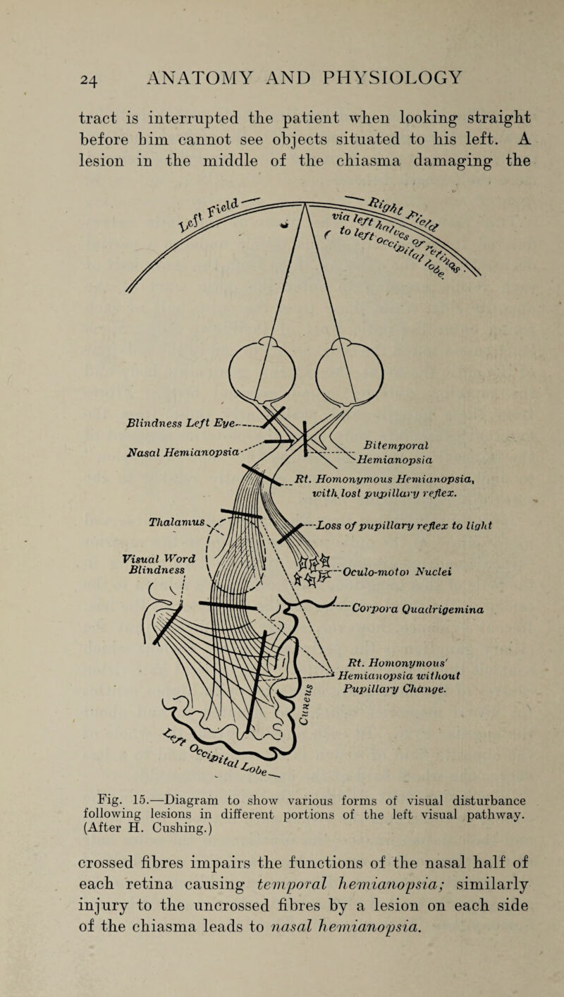 tract is interrupted the patient when looking straight before him cannot see objects situated to his left. A lesion in the middle of the chiasma damaging the Fig. 15.—Diagram to show various forms of visual disturbance following lesions in different portions of the left visual pathway. (After H. Cushing.) crossed fibres impairs the functions of the nasal half of each retina causing temporal hemianopsia; similarly injury to the uncrossed fibres by a lesion on each side of the chiasma leads to nasal hemianopsia.