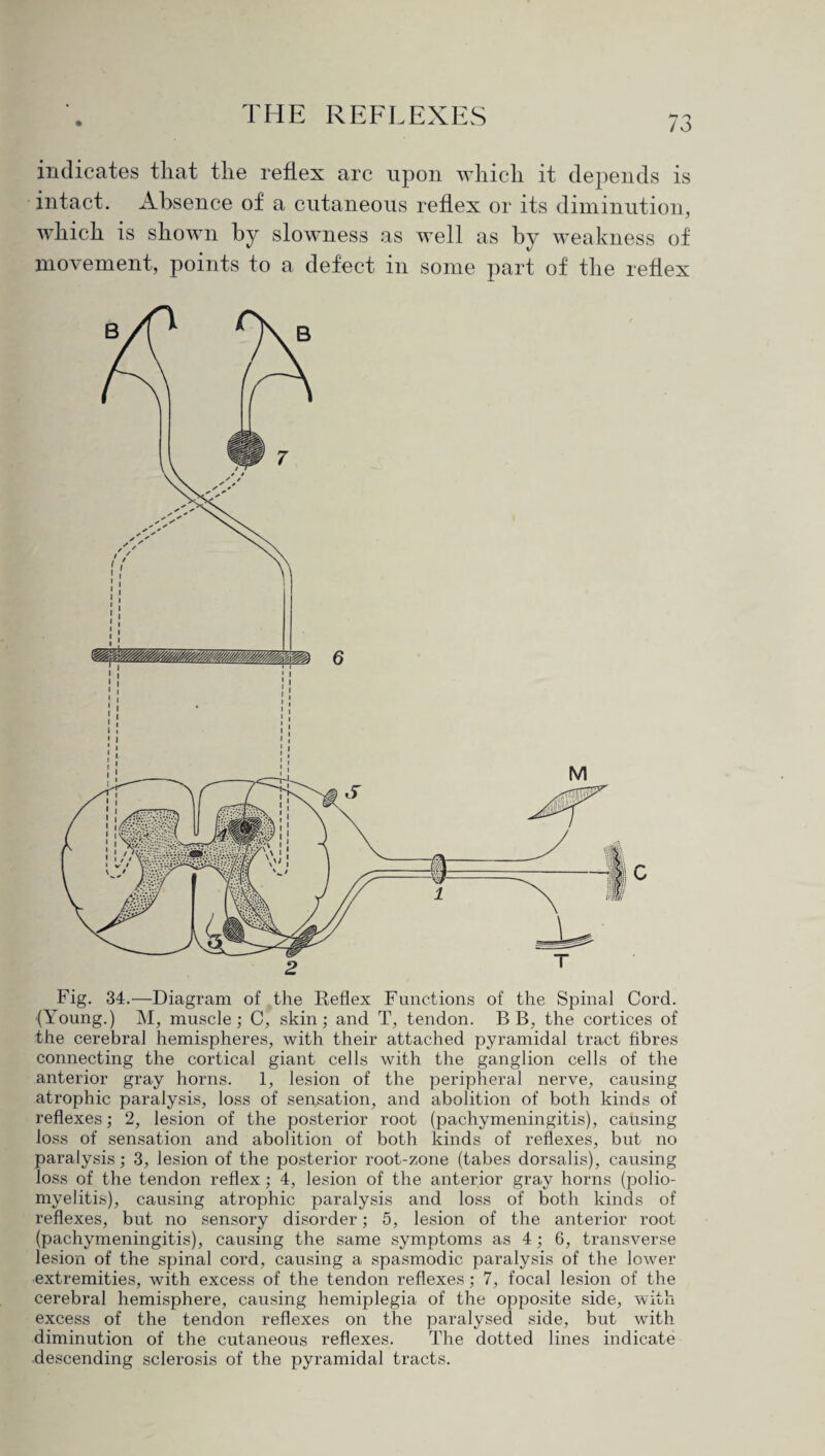 indicates that the reflex arc upon which it depends is intact. Absence of a cutaneous reflex or its diminution, which is shown by slowness as well as by weakness of movement, points to a defect in some part of the reflex Fig. 34.—Diagram of the Reflex Functions of the Spinal Cord. -(Young.) M, muscle; C, skin; and T, tendon. BB, the cortices of the cerebral hemispheres, with their attached pyramidal tract fibres connecting the cortical giant cells with the ganglion cells of the anterior gray horns. 1, lesion of the peripheral nerve, causing atrophic paralysis, loss of sensation, and abolition of both kinds of reflexes; 2, lesion of the posterior root (pachymeningitis), causing loss of sensation and abolition of both kinds of reflexes, but no paralysis; 3, lesion of the posterior root-zone (tabes dorsalis), causing loss of the tendon reflex; 4, lesion of the anterior gray horns (polio¬ myelitis), causing atrophic paralysis and loss of both kinds of reflexes, but no sensory disorder; 5, lesion of the anterior root (pachymeningitis), causing the same symptoms as 4; 6, transverse lesion of the spinal cord, causing a spasmodic paralysis of the lower extremities, with excess of the tendon reflexes; 7, focal lesion of the cerebral hemisphere, causing hemiplegia of the opposite side, with excess of the tendon reflexes on the paralysed side, but with diminution of the cutaneous reflexes. The dotted lines indicate descending sclerosis of the pyramidal tracts.