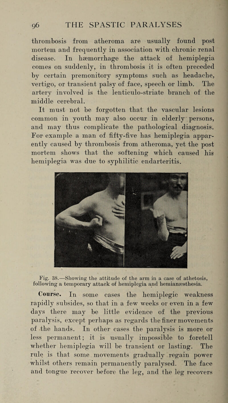 thrombosis from atheroma are usually found post mortem and frequently in association with chronic renal disease. In haemorrhage the attack of hemiplegia conies on suddenly, in thrombosis it is often preceded by certain premonitory symptoms such as headache, vertigo, or transient palsy of face, speech or limb. The artery involved is the lenticulo-striate branch of the t/ middle cerebral. It must not be forgotten that the vascular lesions common in youth may also occur in elderly' persons, and may thus complicate the pathological diagnosis. Tor- example a man of fifty-five has hemiplegia appar¬ ently caused by thrombosis from atheroma, yet the post mortem shows that the softening which caused his hemiplegia was due to syphilitic endarteritis. Fig. 38.—Showing the attitude of the arm in a case of athetosis, following a temporary attack of hemiplegia and hemiansesthesia. Course. In some cases the hemiplegic weakness rapidly subsides, so that in a few weeks or even in a few days there may be little evidence of the previous paralysis, except perhaps as regards the finer movements of the hands. In other cases the paralysis is more or less permanent; it is usually impossible to foretell whether hemiplegia will be transient or lasting. The rule is that some movements gradually regain power whilst others remain permanently paralysed. The face and tongue recover before the leg, and the leg recovers