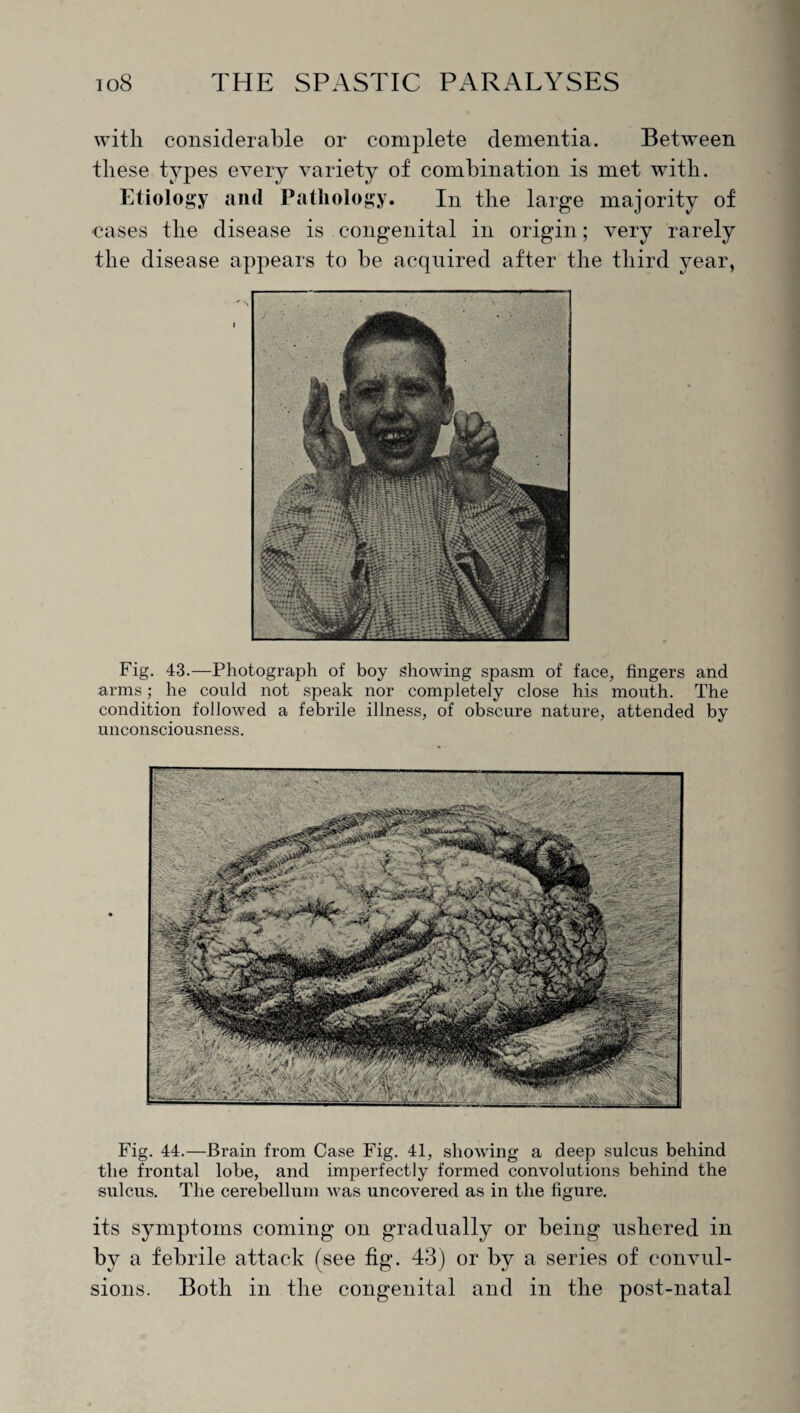 with considerable or complete dementia. Between these types every variety of combination is met with. Etiology and Pathology. In the large majority of cases the disease is congenital in origin; very rarely the disease appears to he acquired after the third year, Fig. 43.—Photograph of boy showing spasm of face, fingers and arms; he could not speak nor completely close his mouth. The condition followed a febrile illness, of obscure nature, attended by unconsciousness. Fig. 44.—Brain from Case Fig. 41, showing a deep sulcus behind the frontal lobe, and imperfectly formed convolutions behind the sulcus. The cerebellum was uncovered as in the figure. its symptoms coming on gradually or being ushered in by a febrile attack (see fig. 43) or by a series of convul¬ sions. Both in the congenital and in the post-natal