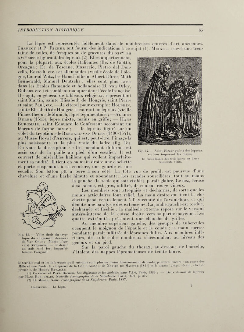 La lèpre est représentée fidèlement dans de nombreuses œuvres d’art anciennes. Charcot et P. Richer ont fourni des indications à ce sujet (1). Meige a relevé une tren¬ taine de toiles, de fresques ou de gravures du xive au xvie siècle figurant des lépreux (2). Elles appartiennent, pour la plupart, aux écoles italiennes (Ec. de Giotto, Orcagna ; Ec. de Toscane, Masaccio, Pietro dcl Don- zello, Rosselli, etc.) et allemandes (vieille école de Colo¬ gne, Conrad Witz, les Hans Holbein, Albert Durer, Math Grünewald, Manuel Deutsch) ; elles sont plus rares dans les Ecoles flamande et hollandaise (R. van Orley, Rubens, etc.) et semblent manquer dans l’école française. Il s’agit, en général de tableaux religieux, représentant saint Martin, sainte Elisabeth de Hongrie, saint Pierre et saint Paul, etc. — Je citerai pour exemple : Holbein, sainte Elisabeth de Hongrie secourant un lépreux (vieille Pinacothèque de Munich, lèpre tégumentaire; —Albert Durer (1513), lèpre mixte, mains en grille; — Hans Burgmair, saint Edouard le Confesseur secourant un lépreux de forme mixte ; — le lépreux figuré sur un volet du tryptique de Bernard van Orley (1490-1541 ), au Musée Royal d’Anvers, cpii est, peut-être, l’image la plus saisissante et la plus vraie du ladre (fig. 15). En voici la description : « Un mendiant difforme est assis sur de la paille au pied d’un escalier. 11 est couvert de misérables haillons qui voilent imparfaite¬ ment sa nudité. 11 tient en sa main droite une clochette et porte suspendue à sa ceinture, une gourde et une écuelle. Son bâton gît à terre à son côté. La tête vue de profil, est pourvue d’une chevelure et d’une barbe hirsute et abondante. Les arcades sourcilières, tout au moins la gauche (la seule qui soit visible), paraît glabre. Le nez, écrasé à sa racine, est gros, infiltré, de couleur rouge vineux. Les membres sont atrophiés et décharnés, de sorte que les nœuds articulaires font relief. La main droite qui tient la clo¬ chette pend verticalement à l’extrémité de l’avant-bras, ce qui dénote une paralysie des extenseurs. La jambe gauche est tordue, décharnée et fléchie ; la malléole externe repose sur le versant antéro-interne de la cuisse droite vers sa partie moyenne. Les quatre extrémités présentent une ébauche de griffes. Au membre supérieur gauche, des groupes de tubercules occupent le moignon de l’épaule et le coude ; la main corres¬ pondante paraît infiltrée de lépromes diffus. Aux membres infé¬ rieurs, des tubercules nombreux s’accumulent au niveau des genoux et du pied. Sur la paroi gauche du thorax, au-dessous de l’aisselle, s’étalent des nappes lépromateuses de teinte fauve. Fig. 14. —Saint-Elzéar guérit des lépreux en leur imposant les mains. Le faciès léonin des trois ladres est d’une saisissante vérité. Fig. 15.— Volet droit du tryp¬ tique du «Jugement dernier» de Van Ohlf.y (Musée d’An¬ vers) (Fragment). — Ce dessin au trait rend fort imparfai¬ tement l’original. le terrible mal et les infortunes qu’il entraîne sont plus ou moins heureusement dépeints, je citerai encore : un conte des Mille et une Nuits, le « Lépreux de la Cité d’Aoste », de Xavier de Maistre (1811) et le drame lyrique récent, « la Lé¬ preuse », de Henry Bataille. (1) Charcot et Paul Richer, Les difformes et les malades dans l’Art, Paris, 1889 ; — Deux dessins de lépreux par Hans Burgkmair, Nouvelle Iconographie de la Salpêtrière, Paris, 1891, p. 327. (2) H. M eige, Nouv. Iconographie de la Salpêtrière, Paris, 1897. 9 Jeanselme. — La Lèpro.