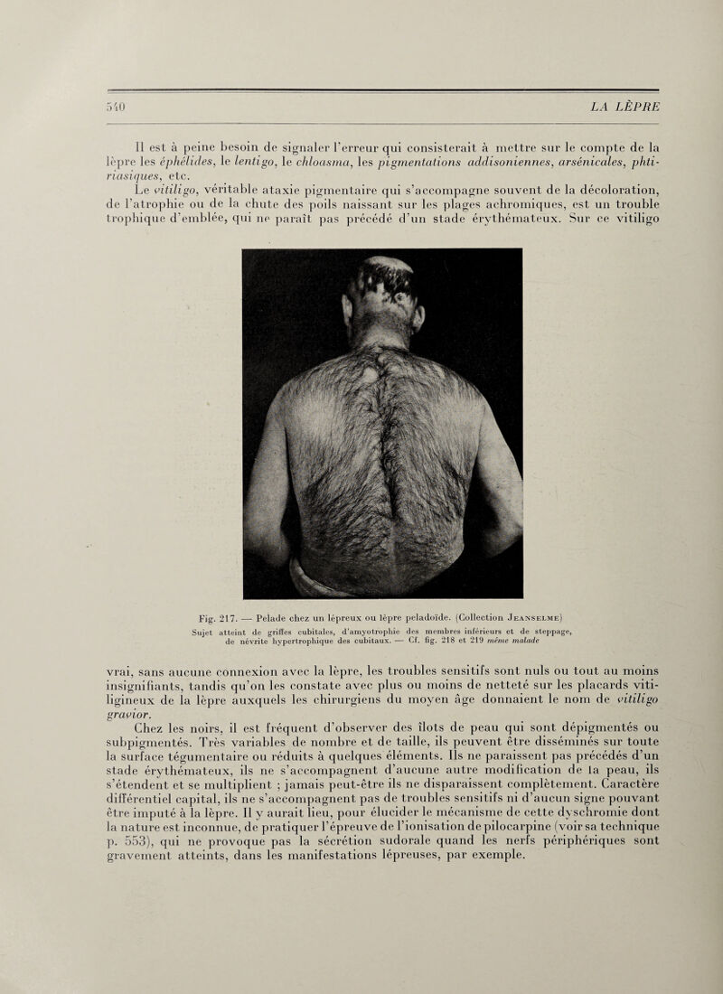 11 est à peine besoin de signaler l’erreur qui consisterait à mettre sur le compte de la lèpre les éphélides, le lentigo, le chloasma, les pigmentations acldisoniennes, arsénicales, phti- riasiques, etc. Le vitiligo, véritable ataxie pigmentaire qui s’accompagne souvent de la décoloration, de l’atrophie ou de la chute des poils naissant sur les plages achromiques, est un trouble trophique d'emblée, qui ne paraît pas précédé d’un stade érythémateux. Sur ce vitiligo Fig. 217. — Pelade chez un lépreux ou lèpre peladoïde. (Collection Jeanselme) Sujet atteint de griffes cubitales, d’amyotrophie des membres inférieurs et de steppage, de névrite hypertrophique des cubitaux. — Cf. fig. 218 et 219 même malade vrai, sans aucune connexion avec la lèpre, les troubles sensitifs sont nuis ou tout au moins insignifiants, tandis qu’on les constate avec plus ou moins de netteté sur les placards viti- ligineux de la lèpre auxquels les chirurgiens du moyen âge donnaient le nom de vitiligo gravior. Chez les noirs, il est fréquent d’observer des îlots de peau qui sont dépigmentés ou subpigmentés. Très variables de nombre et de taille, ils peuvent être disséminés sur toute la surface tégumentaire ou réduits à quelques éléments. Ils ne paraissent pas précédés d’un stade érythémateux, ils ne s’accompagnent d’aucune autre modification de la peau, ils s’étendent et se multiplient ; jamais peut-être ils ne disparaissent complètement. Caractère différentiel capital, ils ne s’accompagnent pas de troubles sensitifs ni d’aucun signe pouvant être imputé à la lèpre. Il y aurait lieu, pour élucider le mécanisme de cette dyschromie dont la nature est inconnue, de pratiquer l’épreuve de l’ionisation de pilocarpine (voir sa technique p. 553), qui ne provoque pas la sécrétion sudorale quand les nerfs périphériques sont gravement atteints, dans les manifestations lépreuses, par exemple.