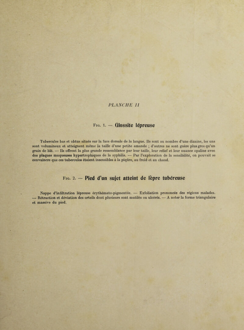 Fig. i. — Glossite lépreuse Tubercules bas et obtus situés sur la face dorsale de la langue. Ils sont au nombre d’une dizaine, les uns sont volumineux et atteignent même la taille d’une petite amande ; d’autres ne sont guère plus gros qu’un grain de blé. — Ils offrent la plus grande ressemblance par leur taille, leur relief et leur nuance opaline avec des plaques muqueuses hypertrophiques de la syphilis. — Par l’exploration de la sensibilité, on pouvait se convaincre que ces tubercules étaient insensibles à la piqûre, au froid et au chaud. Fig. 2. — Pied d’un sujet atteint de lèpre tubéreuse Nappe d’infiltration lépreuse érythémato-pigmentée. — Exfoliation prononcée des régions malades. — Rétraction et déviation des orteils dont plusieurs sont mutilés ou ulcérés. — A noter la forme triangulaire et massive du pied.