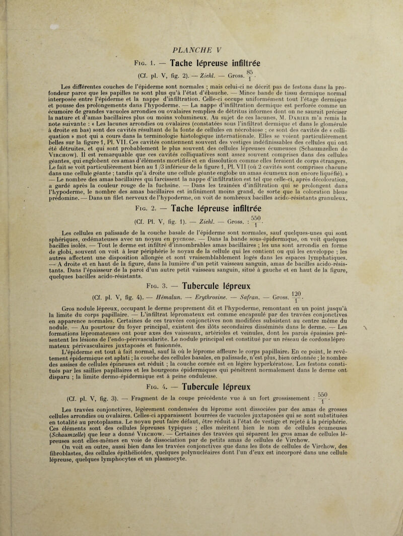 Fig. i. — Tache lépreuse infiltrée (Cf. pl. V, fïg. 2). — Ziehl. — Gross. ®5. Les différentes couches de l’épiderme sont normales ; mais celui-ci ne décrit pas de festons dans la pro¬ fondeur parce que les papilles ne sont plus qu’à l’état d’ébauche. — Mince bande de tissu dermique normal interposée entre l’épiderme et la nappe d’infiltration. Celle-ci occupe uniformément tout l’étage dermique et pousse des prolongements dans l’hypoderme. — La nappe d’infiltration dermique est perforée comme un écumoire de grandes vacuoles arrondies ou ovalaires remplies de détritus informes dont on ne saurait préciser la nature et d’amas bacillaires plus ou moins volumineux. Au sujet de ces lacunes, M. Darier m’a remis la note suivante : « Les lacunes arrondies ou ovalaires (constatées sous l’infîltrat dermique et dans le glomérule à droite en bas) sont des cavités résultant de la fonte de cellules en nécrobiose ; ce sont des cavités de « colli- quation » mot qui a cours dans la terminologie histologique internationale. Elles se voient particulièrement belles sur la figure 1, Pl. VIL Ces cavités contiennent souvent des vestiges indéfinissables des cellules qui ont été détruites, et qui sont probablement le plus souvent des cellules lépreuses écumeuses (Schaumzellen de Virchow). Il est remarquable que ces cavités colliquatives sont assez souvent comprises dans des cellules géantes, qui englobent ces amas d’éléments mortifiés et en dissolution comme elles feraient de corps étrangers. Le fait se voit particulièrement bien au 1 /3 inférieur de la figure 1, Pl. VII (où 2 cavités sont comprises chacune dans une cellule géante ; tandis qu’à droite une cellule géante englobe un amas écumeux non encore liquéfié). » — Le nombre des amas bacillaires qui farcissent la nappe d’infiltration est tel que celle-ci, après décoloration, a gardé après la couleur rouge de la fuchsine. — Dans les trainées d’infiltration qui se prolongent dans l’hypoderme, le nombre des amas bacillaires est infiniment moins grand, de sorte que la coloration bleue prédomine. — Dans un filet nerveux de l’hvpoderme, on voit de nombreux bacilles acido-résistants granuleux. Fig. 2. — Tache lépreuse infiltrée ^o (Cf. Pl. V, fig. 1). — Ziehl. — Gross. : Les cellules en palissade de la couche basale de l’épiderme sont normales, sauf quelques-unes qui sont sphériques, œdémateuses avec un noyau en pvcnose. — Dans la bande sous-épidermique, on voit quelques bacilles isolés. — Tout le derme est infiltré d’innombrables amas bacillaires ; les uns sont arrondis en forme de globi, souvent on voit à leur périphérie le noyau de la cellule qui les contient ou qui les enveloppe ; les autres affectent une disposition allongée et sont vraisemblablement logés dans les espaces lymphatiques. — A droite et en haut de la figure, dans la lumière d’un petit vaisseau sanguin, amas de bacilles acido-résis¬ tants. Dans l’épaisseur de la paroi d’un autre petit vaisseau sanguin, situé à gauche et en haut de la figure, quelques bacilles acido-résistants. Fig. 3. — Tubercule lépreux 120 (Cf. pl. V, fig. 4). — Hémalun. — Erythrosine. — Safran. — Gross. —J-. Gros nodule lépreux, occupant le derme proprement dit et l’hypoderme, remontant en un point jusqu’à la limite du corps papillaire. — L’infiltrat lépromateux est comme encapsulé par des travées conjonctives en apparence normales. Certaines de ces travées conjonctives non modifiées subsistent au centre même du nodule. — Au pourtour du foyer principal, existent des ilôts secondaires disséminés dans le derme. — Les formations lépromateuses ont pour axes des vaisseaux, artérioles et veinules, dont les parois épaissies pré¬ sentent les lésions de l’endo-périvascularite. Le nodule principal est constitué par un réseau de cordons lépro mateux périvasculaires juxtaposés et fusionnés. L’épiderme est tout à fait normal, sauf là où le léprome affleure le corps papillaire.- En ce point, le revê¬ tement épidermique est aplati ; la couche des cellules basales, en palissade, n’est plus, bien ordonnée ; le nombre des assises de cellules épineuses est réduit ; la couche cornée est en légère hyperkératose. Les festons consti¬ tués par les saillies papillaires et les bourgeons épidermiques qui pénètrent normalement dans le derme ont disparu ; la limite dermo-épidermique est à peine onduleuse. Fig. 4. — Tubercule lépreux 550 (Cf. pl. V, fig. 3). —- Fragment de la coupe précédente vue à un fort grossissement : -y-. Les travées conjonctives, légèrement condensées du léprome sont dissociées par des amas de grosses cellules arrondies ou ovalaires. Celles-ci apparaissent bourrées de vacuoles juxtaposées qui se sont substituées en totalité au protoplasma. Le noyau peut faire défaut, être réduit à l’état de vestige et rejeté à la périphérie. Ces éléments sont des cellules lépreuses typiques ; elles méritent bien le nom de cellules écumeuses (Schaumzelle) que leur a donné Virchow. — Certaines des travées qui séparent les gros amas de cellules lé¬ preuses sont elles-mêmes en voie de dissociation par de petits amas de cellules de Virchow. On voit en outre, aussi bien dans les travées conjonctives que dans les îlots de cellules de Virchow, des fibroblastes, des cellules épithélioïdes, quelques polynucléaires dont l’un d’eux est incorporé dans une cellule lépreuse, quelques lymphocytes et un plasmocyte.