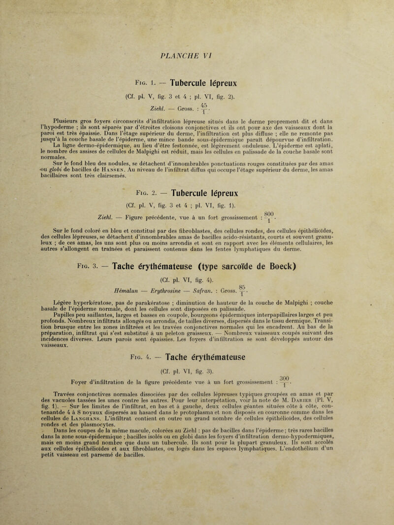 Fig. i. — Tubercule lépreux (Cf. pl. V, fig. 3 et 4 ; pi. VI, fig. 2). Ziehl. — Gross. : Plusieurs gros foyers circonscrits d’infiltration lépreuse situés dans le derme proprement dit et dans l’hypoderme ; ils sont séparés par d’étroites cloisons conjonctives et ils ont pour axe des vaisseaux dont la paroi est très épaissie. Dans l’étage supérieur du derme, l’infiltration est plus diffuse ; elle ne remonte pas jusqu’à la couche basale de l’épiderme, une mince bande sous-épidermique paraît dépourvue d’infiltration. La ligne dermo-épidermique, au lieu d’être festonnée, est légèrement onduleuse. L’épiderme est aplati, le nombre des assises de cellules de Malpighi est réduit, mais les cellules en palissade de la couche basale sont normales. Sur le fond bleu des nodules, se détachent d’innombrables ponctuations rouges constituées par des amas •ou globi de bacilles de Hansen. Au niveau de l’infiltrât diffus qui occupe l’étage supérieur du derme, les amas bacillaires sont très clairsemés. Fig. 2. — Tubercule lépreux (Cf. pl. V, fig. 3 et 4 ; pl. VI, fig. 1). Ziehl. — Figure précédente, vue à un fort grossissement : Sur le fond coloré en bleu et constitué par des fibroblastes, des cellules rondes, des cellules épithélioïdes, des cellules lépreuses, se détachent d’innombrables amas de bacilles acido-résistants, courts et souvent granu¬ leux ; de ces amas, les uns sont plus ou moins arrondis et sont en rapport avec les éléments cellulaires, les autres s’allongent en traînées et paraissent contenus dans les fentes lymphatiques du derme. Fig. 3. — Tache érythémateuse (type sarcoïde de Boeck) (Cf. pl. VI, fig. 4). 85 Hémalun — Erythrosine — Safran. : Gross. ^ • Légère hyperkératose, pas de parakératose ; diminution de hauteur de la couche de Malpighi ; couche basale de l’épiderme normale, dont les cellules sont disposées en palissade. Papilles peu saillantes, larges et basses en coupole, bourgeons épidermiques interpapillaires larges et peu profonds. Nombreux infîltrats allongés ou arrondis, de tailles diverses, dispersés dans le tissu dermique. Transi¬ tion brusque entre les zones infiltrées et les travées conjonctives normales qui les encadrent. Au bas de la préparation, infiltrât qui s’est substitué à un peleton graisseux. — Nombreux vaisseaux coupés suivant des incidences diverses. Leurs parois sont épaissies. Les foyers d’infiltration se sont développés autour des vaisseaux. Fig. 4. — Tache érythémateuse (Cf. pl. VI, fig. 3). Foyer d’infiltration de la figure précédente vue à un fort grossissement : —• Travées conjonctives normales dissociées par des cellules lépreuses typiques groupées en amas et par des vacuoles tassées les unes contre les autres. Pour leur interpétation, voir la note de M. Darier (Pl. V, fig. 1). — Sur les limites de l’infiltrat, en bas et à gauche, deux cellules géantes situées côte à côte, con- tenantde 4 à 8 noyaux dispersés au hasard dans le protoplasma et non disposés en couronne comme dans les cellules de Langhans. L’infiltrat contient en outre un grand nombre de cellules épithélioïdes, des cellules rondes et des plasmocytes. Dans les coupes de la même macule, colorées au Ziehl : pas de bacilles dans l’épiderme ; très rares bacilles dans la zone sous-épidermique ; bacilles isolés ou en globi dans les foyers d’infiltration dermo-hypodermiques, mais en moins grand nombre que dans un tubercule. Ils sont pour la plupart granuleux. Ils sont accolés aux cellules épithélioïdes et aux fibroblastes, ou logés dans les espaces lymphatiques. L’endothélium d’un petit vaisseau est parsemé de bacilles.