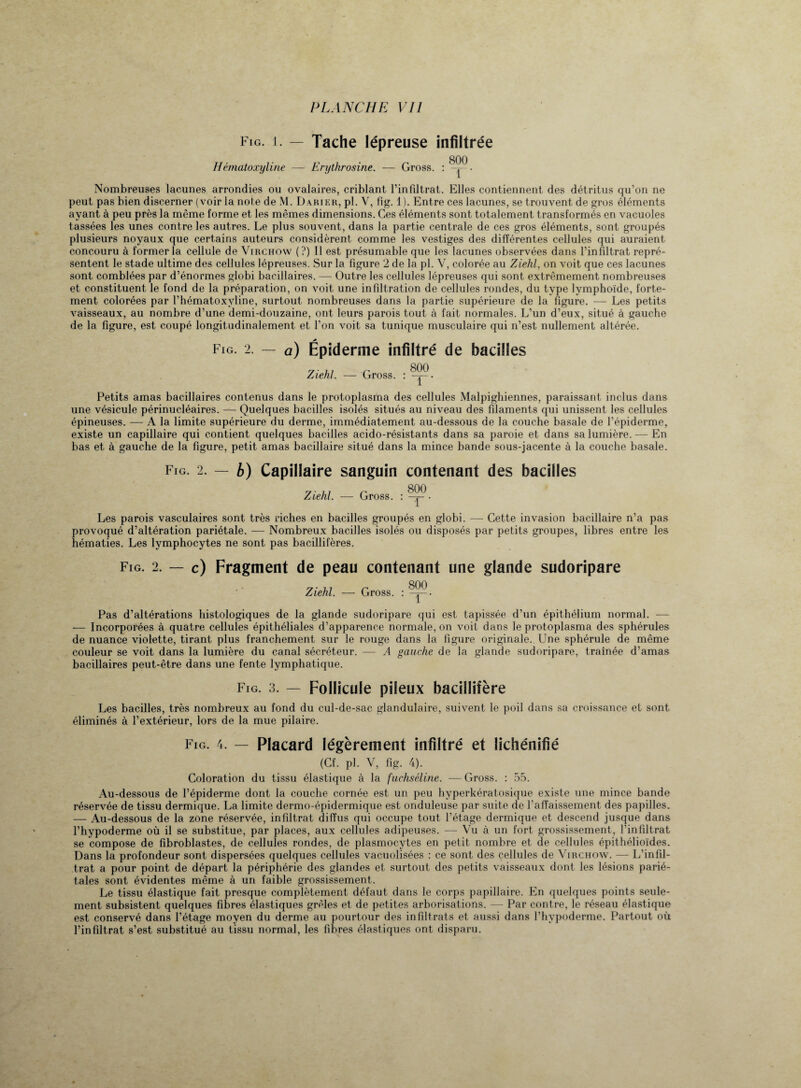 Fig. 1. — Tache lépreuse infiltrée Hématoxyline — Erythrosine. Gross. : 800 1 ‘ Nombreuses lacunes arrondies ou ovalaires, criblant l’infiltrat. Elles contiennent des détritus qu’on ne peut pas bien discerner (voir la note de M. Darier, pl. V, fig. 1). Entre ces lacunes, se trouvent de gros éléments ayant à peu près la même forme et les mêmes dimensions. Ces éléments sont totalement transformés en vacuoles tassées les unes contre les autres. Le plus souvent, dans la partie centrale de ces gros éléments, sont groupés plusieurs noyaux que certains auteurs considèrent comme les vestiges des différentes cellules qui auraient concouru à former la cellule de Virchow (?) Il est présumable que les lacunes observées dans l’infiltrat repré¬ sentent le stade ultime des cellules lépreuses. Sur la figure 2 de la pl. V, colorée au Ziehl, on voit que ces lacunes sont comblées par d’énormes globi bacillaires. — Outre les cellules lépreuses qui sont extrêmement nombreuses et constituent le fond de la préparation, on voit une infiltration de cellules rondes, du type lymphoïde, forte¬ ment colorées par l’hématoxyline, surtout nombreuses dans la partie supérieure de la figure. — Les petits vaisseaux, au nombre d’une demi-douzaine, ont leurs parois tout à fait normales. L’un d’eux, situé à gauche de la figure, est coupé longitudinalement et l’on voit sa tunique musculaire qui n’est nullement altérée. Fig. 2. — a) Épiderme infiltré de bacilles Ziehl. — Gross. : Petits amas bacillaires contenus dans le protoplasma des cellules Malpighiennes, paraissant inclus dans une vésicule périnucléaires. — Quelques bacilles isolés situés au niveau des filaments qui unissent les cellules épineuses. — A la limite supérieure du derme, immédiatement au-dessous de la couche basale de l’épiderme, existe un capillaire qui contient quelques bacilles acido-résistants dans sa paroie et dans sa lumière. — En bas et à gauche de la figure, petit amas bacillaire situé dans la mince bande sous-jacente à la couche basale. Fig. 2. — b) Capillaire sanguin contenant des bacilles Ziehl. — Gross. : . Les parois vasculaires sont très riches en bacilles groupés en globi. — Cette invasion bacillaire n’a pas provoqué d’altération pariétale. — Nombreux bacilles isolés ou disposés par petits groupes, libres entre les hématies. Les lymphocytes ne sont pas bacillifères. Fig. 2. — c) Fragment de peau contenant une glande sudoripare Ziehl. — Gross. : Pas d’altérations histologiques de la glande sudoripare qui est tapissée d’un épithélium normal. -— — Incorporées à quatre cellules épithéliales d’apparence normale, on voit dans le protoplasma des sphérules de nuance violette, tirant plus franchement sur le rouge dans la figure originale.. Une sphérule de même couleur se voit dans la lumière du canal sécréteur. — A gauche de la glande sudoripare, traînée d’amas bacillaires peut-être dans une fente lymphatique. Fig. 3. — Follicule pileux bacillifère Les bacilles, très nombreux au fond du cul-de-sac glandulaire, suivent le poil dans sa croissance et sont éliminés à l’extérieur, lors de la mue pilaire. Fig. 4. — Placard légèrement infiltré et lichénifié (Cf. pl. V, fig. 4). Coloration du tissu élastique à la fuchséline. — Gross. : 55. Au-dessous de l’épiderme dont la couche cornée est un peu hyperkératosique existe une mince bande réservée de tissu dermique. La limite dermo-épidermique est onduleuse par suite de l’aiTaissement des papilles. — Au-dessous de la zone réservée, infiltrat diffus qui occupe tout l’étage dermique et descend jusque dans l’hypoderme où il se substitue, par places, aux cellules adipeuses. —• Vu à un fort grossissement, l’infiltrat se compose de fibroblastes, de cellules rondes, de plasmocytes en petit nombre et de cellules épithélioïdes. Dans la profondeur sont dispersées quelques cellules vacuolisées : ce sont des cellules de Virchow. — L’infil- trat a pour point de départ la périphérie des glandes et surtout des petits vaisseaux dont les lésions parié¬ tales sont évidentes même à un faible grossissement. Le tissu élastique fait presque complètement défaut dans le corps papillaire. En quelques points seule¬ ment subsistent quelques fibres élastiques grêles et de petites arborisations. — Par contre, le réseau élastique est conservé dans l’étage moyen du derme au pourtour des infiltrats et aussi dans l’hypoderme. Partout où l’infiltrat s’est substitué au tissu normal, les fibres élastiques ont disparu.