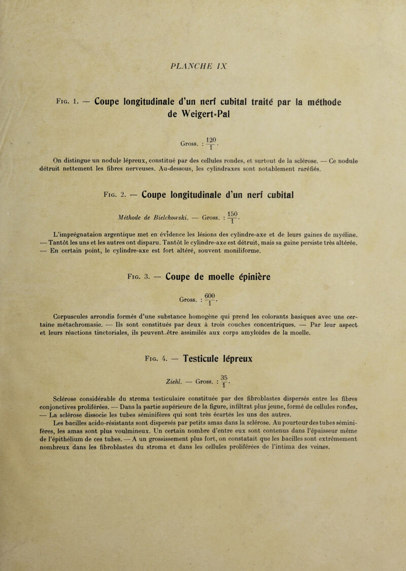 Fig. i. — Coupe longitudinale d’un nerf cubital traité par la méthode de Weigert=Pal Gross. 120 1 On distingue un nodule lépreux, constitué par des cellules rondes, et surtout de la sclérose. — Ce nodule détruit nettement les fibres nerveuses. Au-dessous, les cylindraxes sont notablement raréfiés. Fig. 2. — Coupe longitudinale d’un nerf cubital Méthode de Bielchowski. — Gross. 150 1 L’imprégnataion argentique met en évidence les lésions des cylindre-axe et de leurs gaines de myéline. — Tantôt les uns et les autres ont disparu. Tantôt le cylindre-axe est détruit, mais sa gaine persiste très altérée. — En certain point, le cylindre-axe est fort altéré, souvent moniliforme. Fig. 3. — Coupe de moelle épinière Gross. : 600 Corpuscules arrondis formés d’une substance homogène qui prend les colorants basiques avec une cer¬ taine métachromasie. — Ils sont constitués par deux à trois couches concentriques. — Par leur aspect et leurs réactions tinctoriales, ils peuvent-être assimilés aux corps amyloïdes de la moelle. Fig. 4. — Testicule lépreux Ziehl. Gross. : 35 r* Sclérose considérable du stroma testiculaire constituée par des fibroblastes dispersés entre les fibres conjonctives proliférées. — Dans la partie supérieure de la figure, infiltrat plus jeune, formé de cellules rondes. — La sclérose dissocie les tubes séminifères qui sont très écartés les uns des autres. Les bacilles acido-résistants sont dispersés par petits amas dans la sclérose. Au pourtour des tubes sémini¬ fères, les amas sont plus voulmineux. Un certain nombre d’entre eux sont contenus dans l’épaisseur même de l’épithélium de ces tubes. — A un grossissement plus fort, on constatait que les bacilles sont extrêmement nombreux dans les fibroblastes du stroma et dans les cellules proliférées de l’intima des veines.