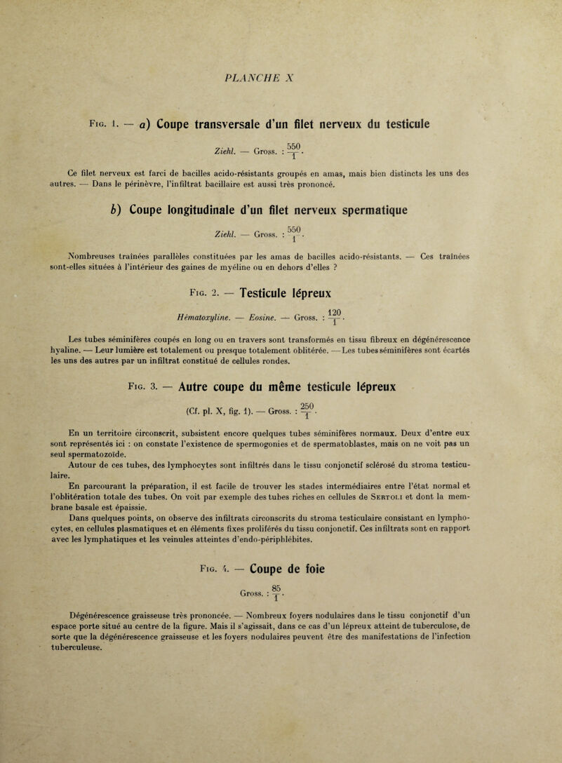 Fig. j. — a) Coupe transversale d’un filet nerveux du testicule Ziehl. — Gross. : -y • Ce filet nerveux est farci de bacilles acido-résistants groupés en amas, mais bien distincts les uns des autres. -—- Dans le périnèvre, l’infiltrat bacillaire est aussi très prononcé. b) Coupe longitudinale d’un filet nerveux spermatique Ziehl. — Gross. : . Nombreuses traînées parallèles constituées par les amas de bacilles acido-résistants. — Ces traînées sont-elles situées à l’intérieur des gaines de myéline ou en dehors d’elles ? Fig. 2. — Testicule lépreux Hématoxyline. — Eosine. — Gross. : -y . Les tubes séminifères coupés en long ou en travers sont transformés en tissu fibreux en dégénérescence hyaline. — Leur lumière est totalement ou presque totalement oblitérée. —Les tubes séminifères sont écartés les uns des autres par un infiltrat constitué de cellules rondes. Fig. 3. — Autre coupe du même testicule lépreux oc.n (Cf. pl. X, fig. 1). — Gross. : En un territoire circonscrit, subsistent encore quelques tubes séminifères normaux. Deux d’entre eux sont représentés ici : on constate l’existence de spermogonies et de spermatoblastes, mais on ne voit pas un seul spermatozoïde. Autour de ces tubes, des lymphocytes sont infiltrés dans le tissu conjonctif sclérosé du stroma testicu¬ laire. En parcourant la préparation, il est facile de trouver les stades intermédiaires entre l’état normal et l’oblitération totale des tubes. On voit par exemple des tubes riches en cellules de Sertoli et dont la mem¬ brane basale est épaissie. Dans quelques points, on observe des infiltrats circonscrits du stroma testiculaire consistant en lympho¬ cytes, en cellules plasmatiques et en éléments fixes proliférés du tissu conjonctif. Ces infiltrats sont en rapport avec les lymphatiques et les veinules atteintes d’endo-périphlébites. Fig. 4. — Coupe de foie r 85 Gross. : -g-. 1 Dégénérescence graisseuse très prononcée. — Nombreux foyers nodulaires dans le tissu conjonctif d’un espace porte situé au centre de la figure. Mais il s’agissait, dans ce cas d’un lépreux atteint de tuberculose, de sorte que la dégénérescence graisseuse et les foyers nodulaires peuvent être des manifestations de l’infection tuberculeuse.