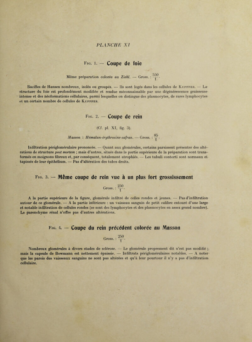 Fig. i. — Coupe de foie Même préparation colorée au Ziehl. — Gross. : 550 1 Bacilles de Hansen nombreux, isolés ou groupés. — ils sont logés dans les cellules de Kupffer. — La- structure du foie est profondément modifiée et rendue méconnaissable par une dégénérescence graisseuse intense et des néoformations cellulaires, parmi lesquelles on distingue des plasmocytes, de rares lymphocytes et un certain nombre de cellules de Kupffer. Fig. 2. — Coupe de rein (Cf. pl. XI, fig. 3). Masson : Hémalun-érythrosine-safran. — Gross. 85 1 Infiltration périglomérulaire prononcée. — Quant aux glomérules, certains paraissent présenter des alté¬ rations de structure post mortem ; mais d’autres, situés dans la partie supérieure de la préparation sont trans¬ formés en moignons fibreux et, par conséquent, totalement atrophiés. — Les tubuli contorti sont normaux et tapissés de leur épithélium. — Pas d’altération des tubes droits. Fig. 3. — Même coupe de rein vue à un plus fort grossissement Gross. : 250 1 A la partie supérieure de la figure, glomérule infiltré de celles rondes et jeunes. — Pas d’infiltration autour de ce glomérule. — A la partie inférieure : un vaisseau sanguin de petit calibre entouré d’une large et notable infiltration de cellules rondes (ce sont des lymphocytes et des plasmocytes en assez grand nombre). Le parenchyme rénal n’offre pas d’autres altérations. Fig. 4. — Coupe du rein précédent colorée au Masson G 250 ross. : y'• Nombreux glomérules à divers stades de sclérose. — Le glomérule proprement dit n’est pas modifié ; mais la capsule de Bowmann est nettement épaissie. — In filtrats périglomérulaires notables. — A noter que les parois des vaisseaux sanguins ne sont pas altérées et qu’à leur pourtour il n’y a pas d’infiltration cellulaire.