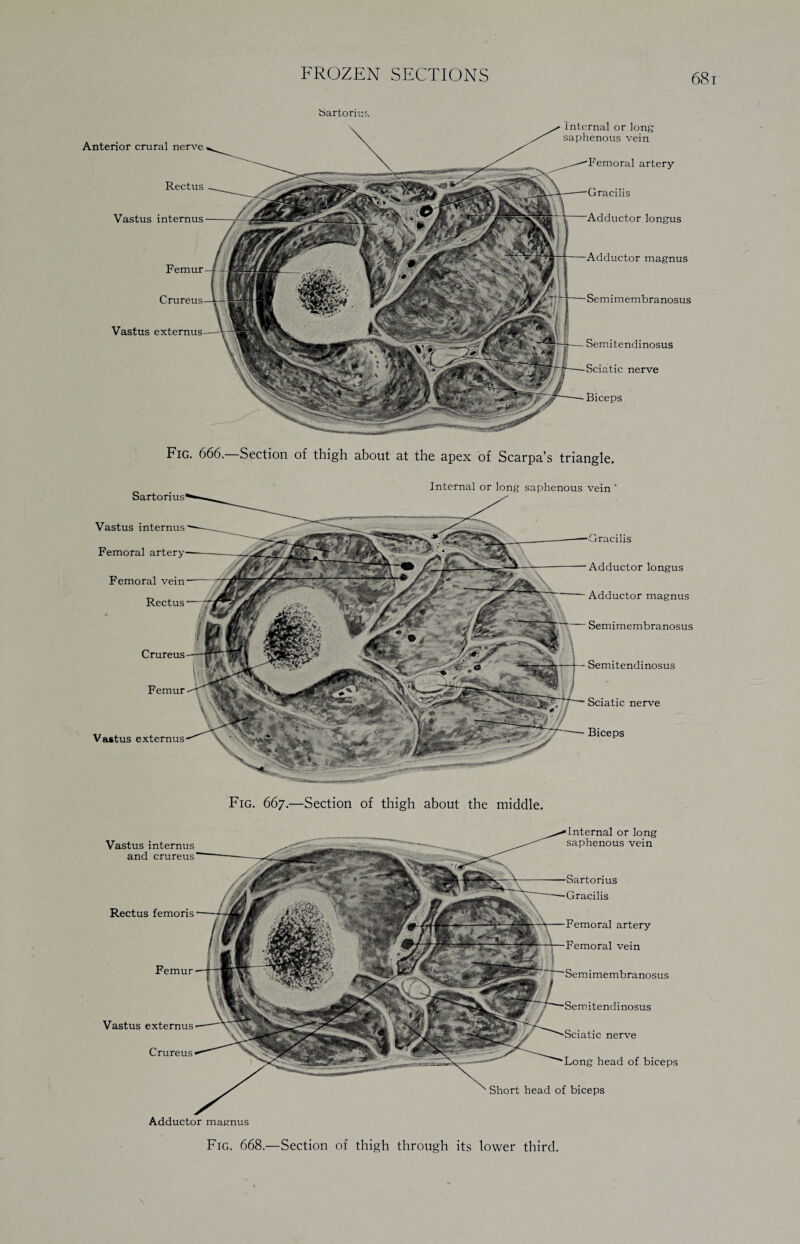 68 bartoriu'. Anterior crural nerve Rectus Vastus internus Femur Internal or long saphenous vein Femoral artery 'lis Adductor longus Adductor magnus Semimembranosus Semitendinosus Sciatic nerve Vastus Fig. 666.—Section of thigh about at the apex of Scarpa’s triangle. Vastus internus Femoral Femoral vein Rectus Crureus Femur Internal or long saphenous vein ' Vastus externus 'lis Adductor longus Adductor magnus Semimembranosus Semitendinosus Sciatic nerve Biceps Fig. 667.—Section of thigh about the middle. Internal or long saphenous vein us Gracilis Femoral artery Femoral vein dinosus nerve Long head of biceps Short head of biceps Rectus femoris Femur Vastus externus Crureus Vastus internus and crureus Adductor magnus Fig. 668.—Section of thigh through its lower third.