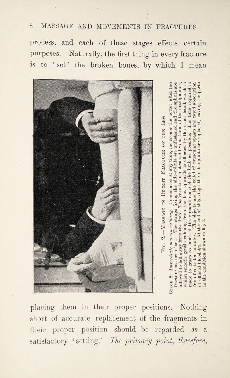 process, and each of these stages effects certain purposes. Naturally, the first thing in every fracture is to ‘ set ’ the broken bones, by which I mean © fa -+= u © 43 © c3 CO 43 M c3 fa „ fa u « © fa 43 O 3 H w H fa O fa fa £ Eh Q <1 fa pH EH 55 fa Q fa fa in m CM d HH [fa © •43 43 © fa sT CO dUl I—I • rH g fa & > 4 £ fa~ a § fa CO • r4 fa © 54 • rH P fa © 44 P o co 43 54 43 c3 fa fa u © fa 43 o CO fa c3 bo © 5-4 © p o o CO © fa fa P c3 fa fa © pj © ifa 43 44 O 54 © fa ©rs.s p fa > 5 g © <U fa ~ EH 1:3 p © 43 CO c3 44 p p © <H © © 54 c3 CO 43 c3 fa © P O 43 © © fa © 43 ^© !>ifa fa K c3 43 <3 CO © © p © fa CO I © fa rH to © fa fa © • f-H fa c3 © 43 CO P © fa 43 CO O O © 43 Q gf-S • rr fl} X fa ^fa • C5 r-0 i s qq irj co • pH to fa 54 c6 is fa P 43 o o co co O fa1 © c3 fa a CO a fa CO 54 ®3 p © © p fa © © c3 —i fa © 54 © 54 c3 co © fa 43 © © P © 54 © 44 £ * <S> -O r-O o 54 HS 44 o o i CO 44 <45 rO § S © © 43 © to o 54 «44 >3' c3 £ c3 © hfcfa P ^ 1 = P 54 44 o 44 © * rH 54 © fa 43 © 54 c3 to 43 © © • I—1 fa O © fa fa to I o nd • rH c0 o o hO c3 CO CO • rH fa 43 fa P © &2 -3 © -4 43 P © be to © 43 p p 43 C © s=3 W © < Eh CO to £ i-j © c3 44 O 43 fa © £ o ^ £ fa s 54 O bC-^ O g ^ fa © 4 fa P cS a bo fa P • pH P is o fa to P O • rH fa rS fa fH rH o © © rH rH H^> P fa © o fa © to P fa © O 4c c fa placing them in their proper positions. Nothing short of accurate replacement of the fragments in their proper position should be regarded as a satisfactory ‘setting.’ The primary point, therefore,