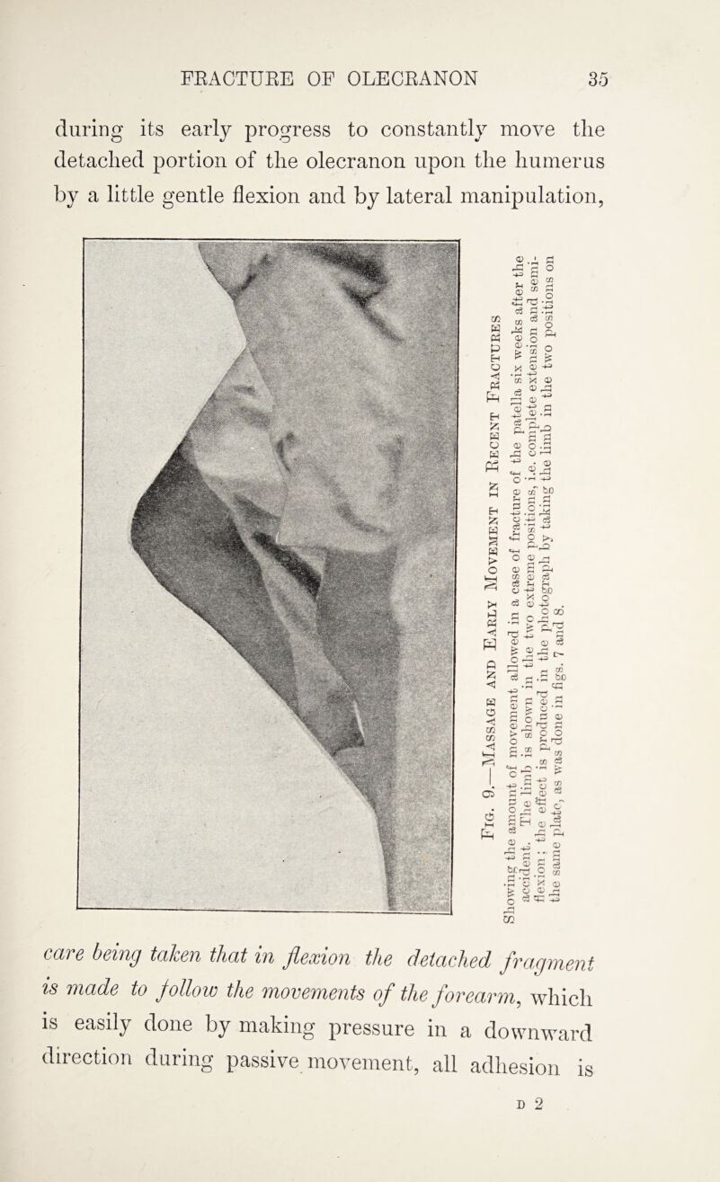 during its early progress to constantly move tlie detached portion of tlie olecranon upon the humerus by a little gentle flexion and by lateral manipulation, GQ care being taken that in flexion the detached fragment is made to follow the movements of the forearm, which is easily done by making pressure in a downward direction during passive movement, all adhesion is