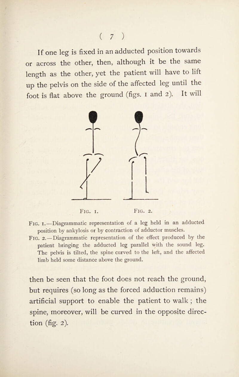 If one leg is fixed in an adducted position towards or across the other, then, although it be the same length as the other, yet the patient will have to lift up the pelvis on the side of the affected leg until the foot is flat above the ground (figs. I and 2). It will T 7 Fig. 1.—Diagrammatic representation of a leg held in an adducted position by ankylosis or by contraction of adductor muscles. Fig. 2. — Diagrammatic representation of the effect produced by the patient bringing the adducted leg parallel with the sound leg. The pelvis is tilted, the spine curved to the left, and the affected limb held some distance above the ground. then be seen that the foot does not reach the ground, but requires (so long as the forced adduction remains) artificial support to enable the patient to walk ; the spine, moreover, will be curved in the opposite direc¬ tion (fig. 2).