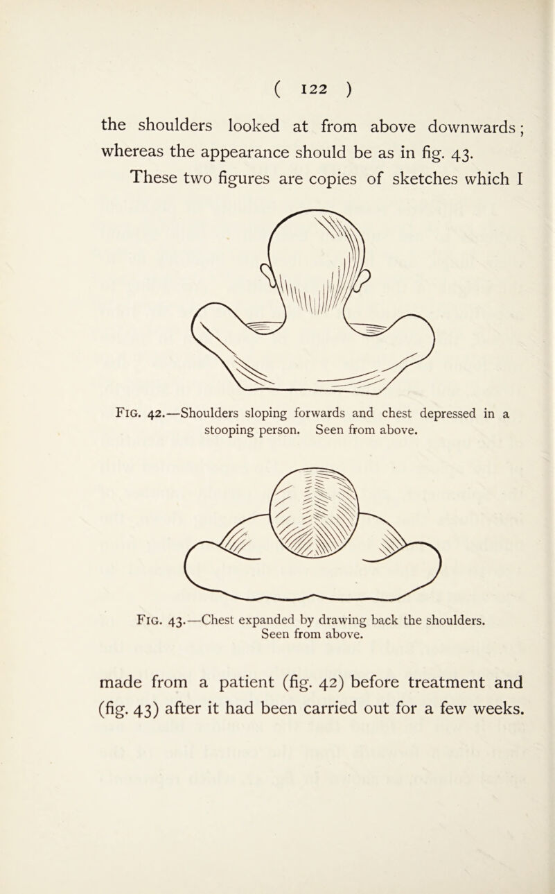 the shoulders looked at from above downwards; whereas the appearance should be as in fig. 43. These two figures are copies of sketches which I Fig. 42.—Shoulders sloping forwards and chest depressed in a stooping person. Seen from above. Fig. 43.—Chest expanded by drawing back the shoulders. Seen from above. made from a patient (fig. 42) before treatment and (fig. 43) after it had been carried out for a few weeks.