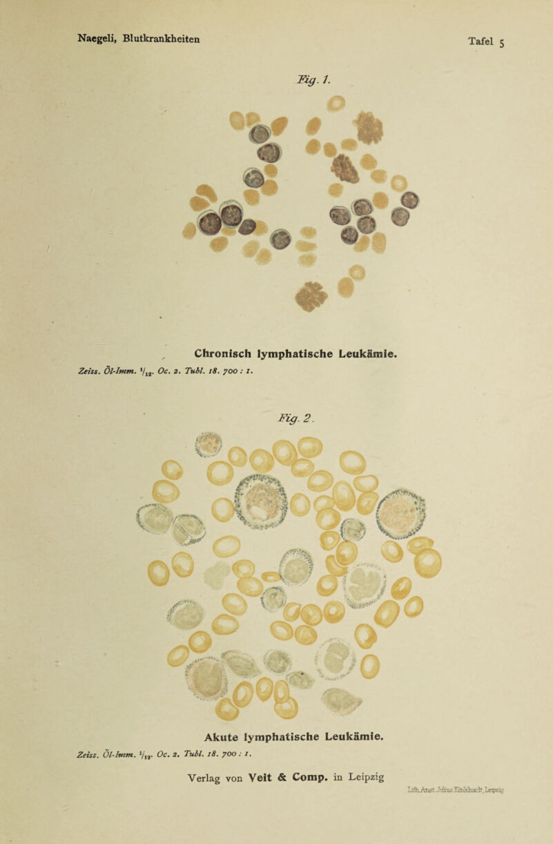 Fzg. 1. Chronisch lymphatische Leukämie. Zeiss. Öl-Itnm. l/12. Oc. 2. Tubl. 18. 700 : I. Fig.2. Akute lymphatische Leukämie. Zeiss. Öl-Itnm. 7,a. Oc. 2. Tubl. 18. 700: 1. Verlag von Veit & Comp, in Leipzig