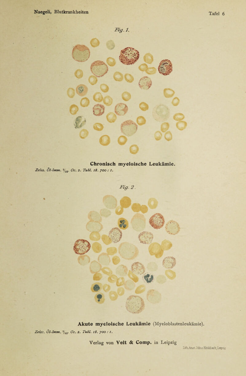 Tiy.1. Sm Chronisch myeloische Leukämie. Zeiss. Ol-I?nm. yi2. Oc. 2. Tubl. 18. 700 : 1. Fü}.2. Akute myeloische Leukämie (Myeloblastenleukämie). Zeis:, Öl-Imm. 1ji2. Oc. 2. Tubl. 18. 700 : 1. Tafel 6 Verlag von Veit & Comp, in Leipzig