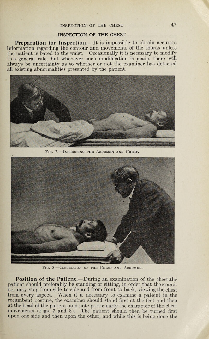 INSPECTION OF THE CHEST Preparation for Inspection.—It is impossible to obtain accurate information regarding the contour and movements of the thorax unless the patient is bared to the waist. Occasionally it is necessary to modify this general rule, but whenever such modification is made, there will always be uncertainty as to whether or not the examiner has detected all existing abnormalities presented by the patient. Fig. 7.—Inspecting the Abdomen and Chest. Fig. 8.—Inspection of the Chest and Abdomen. Position of the Patient.—During an examination of the chest kthe patient should preferably be standing or sitting, in order that the exami¬ ner may step from side to side and from front to back, viewing the chest from every aspect. When it is necessary to examine a patient in the recumbent posture, the examiner should stand first at the feet and then at the head of the patient, and note particularly the character of the chest movements (Figs.. 7 and 8). The patient should then be turned first upon one side and then upon the other, and while this is being done the
